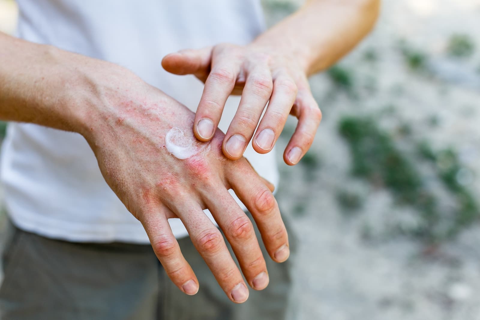 eczema