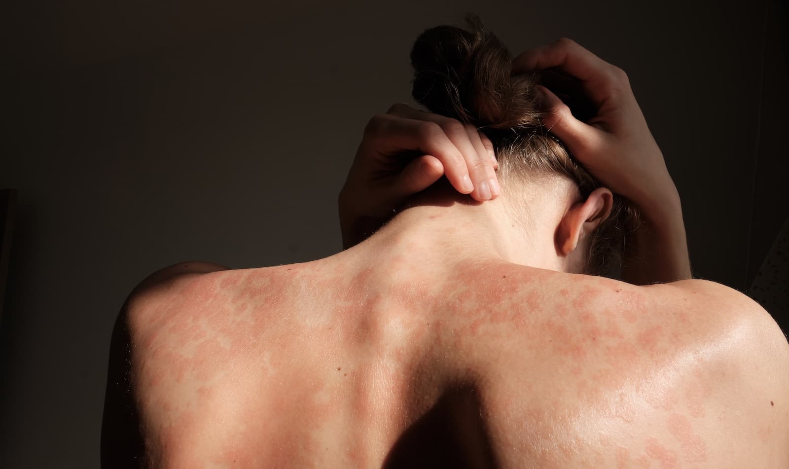 psoriasis