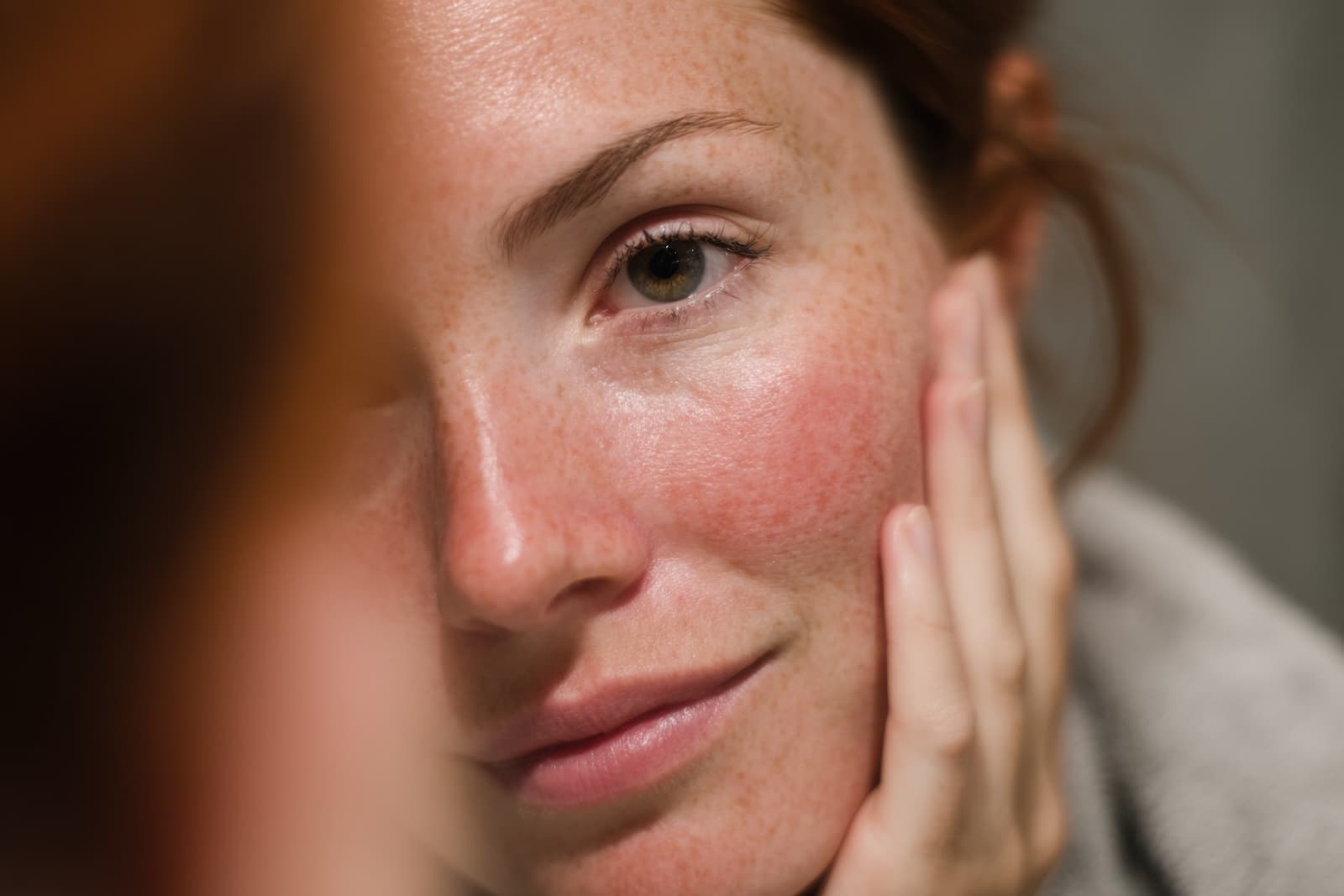 rosacea
