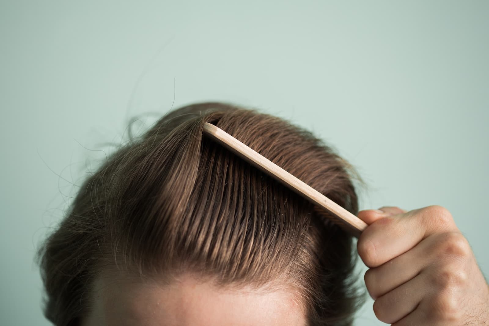 male-hair-loss-androgenic-alopecia