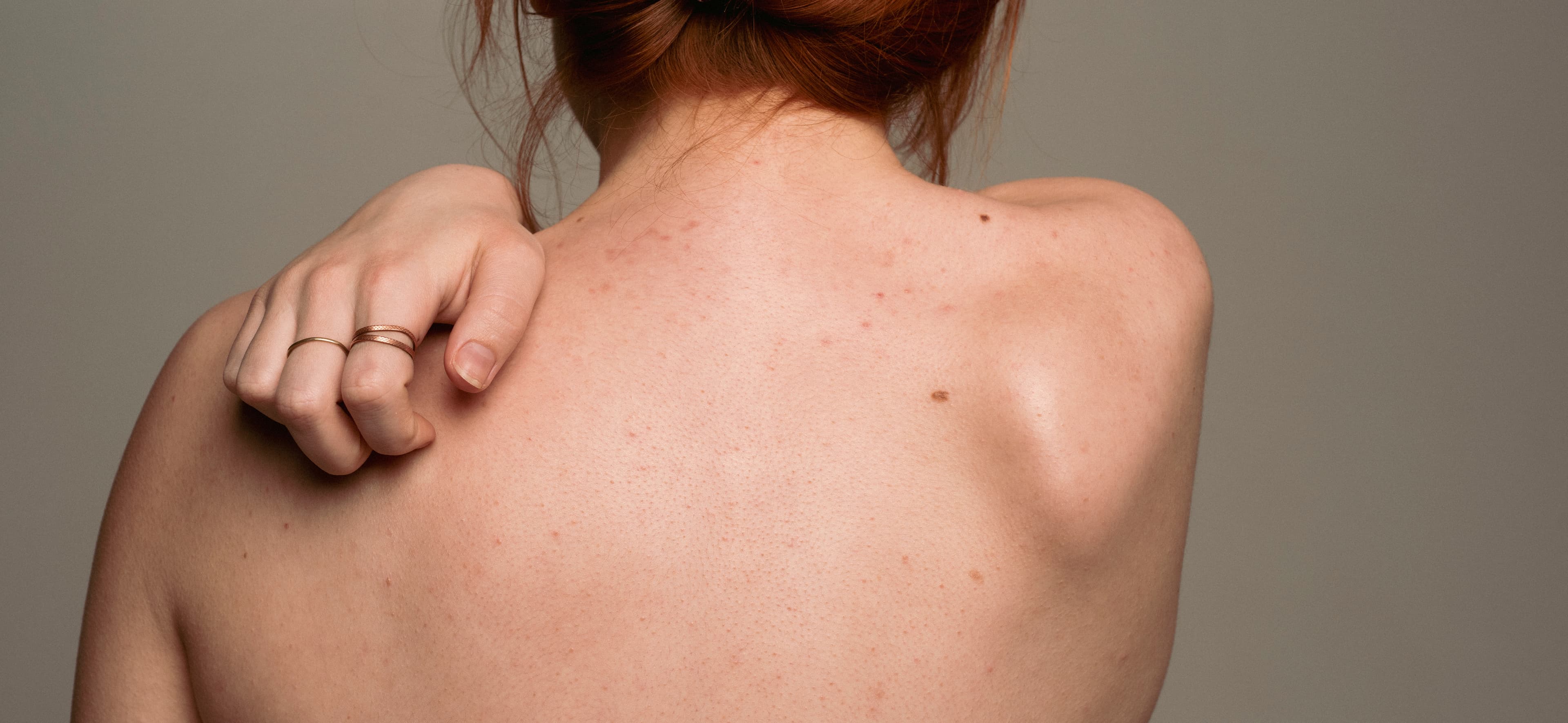 Shingles