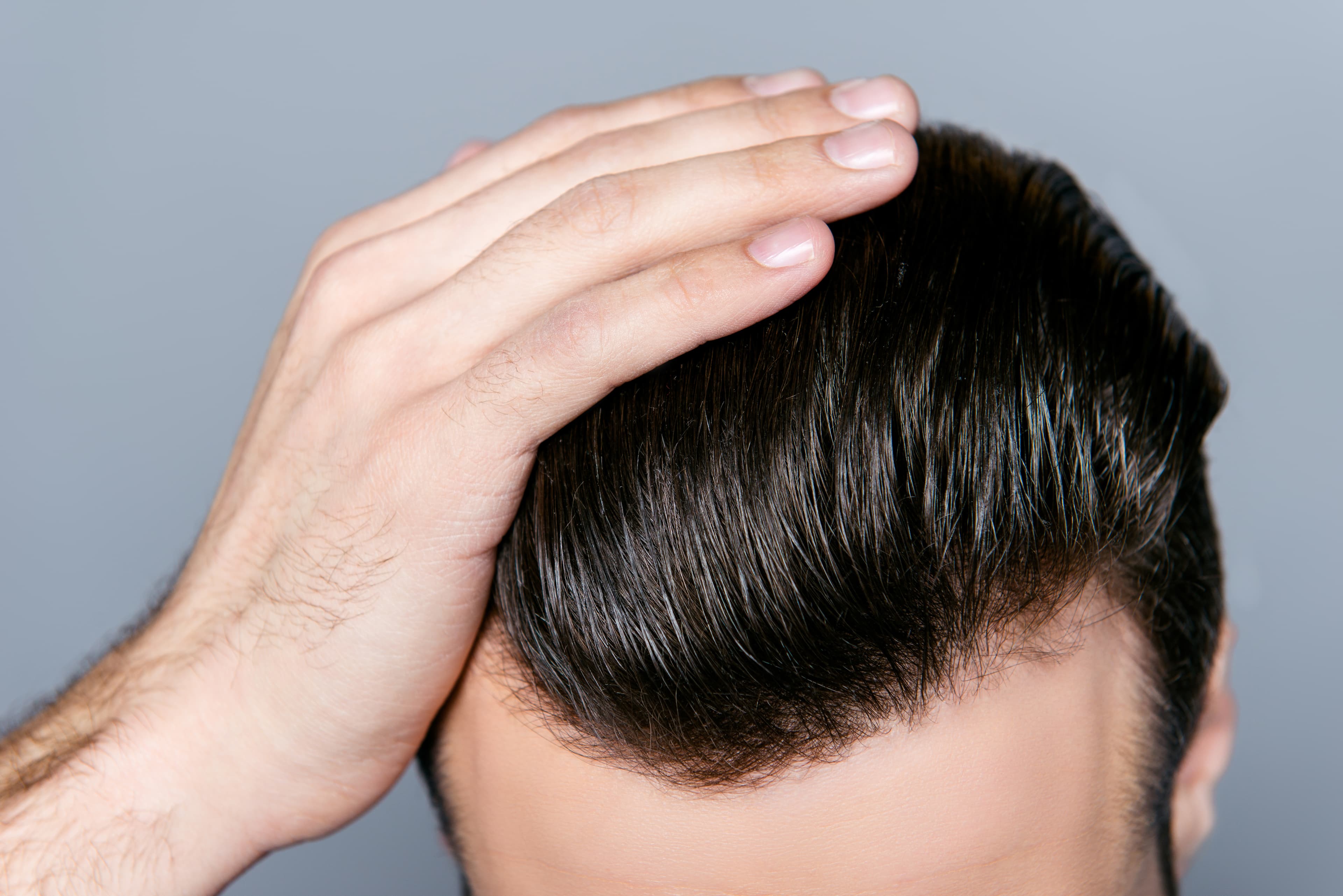 Dandruff