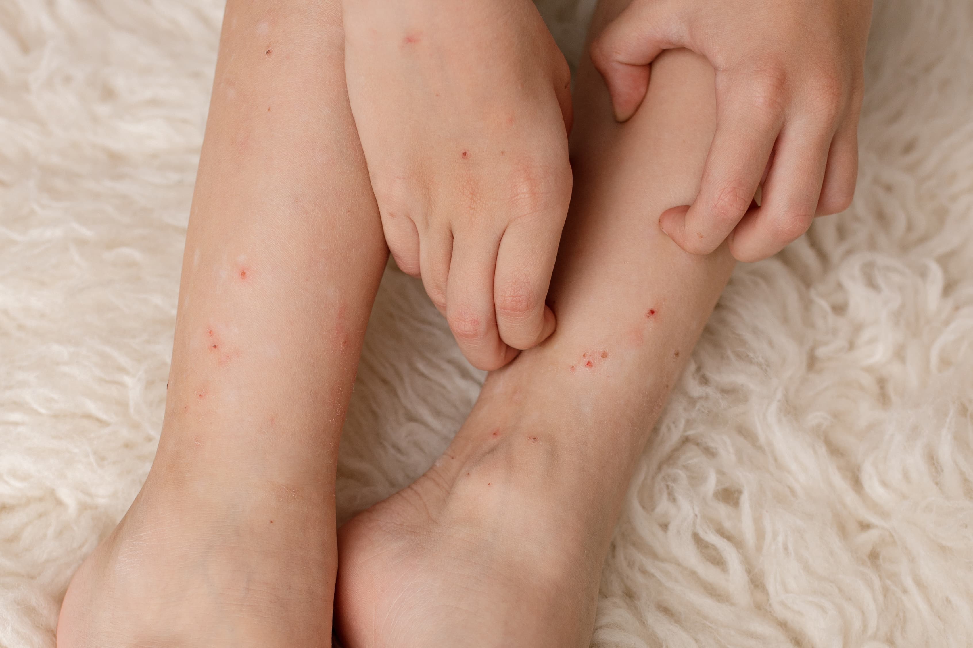 Insect bite