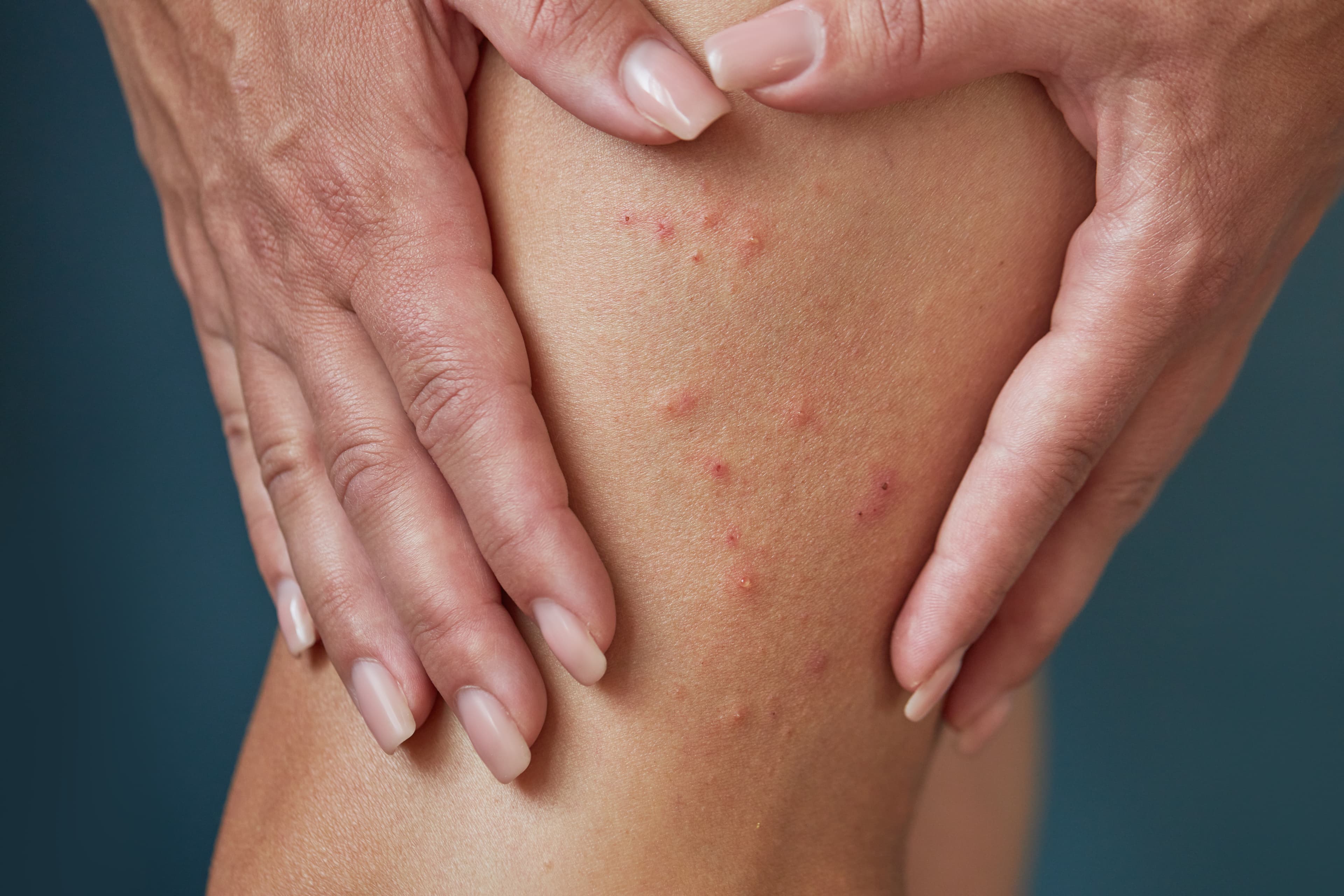 scabies