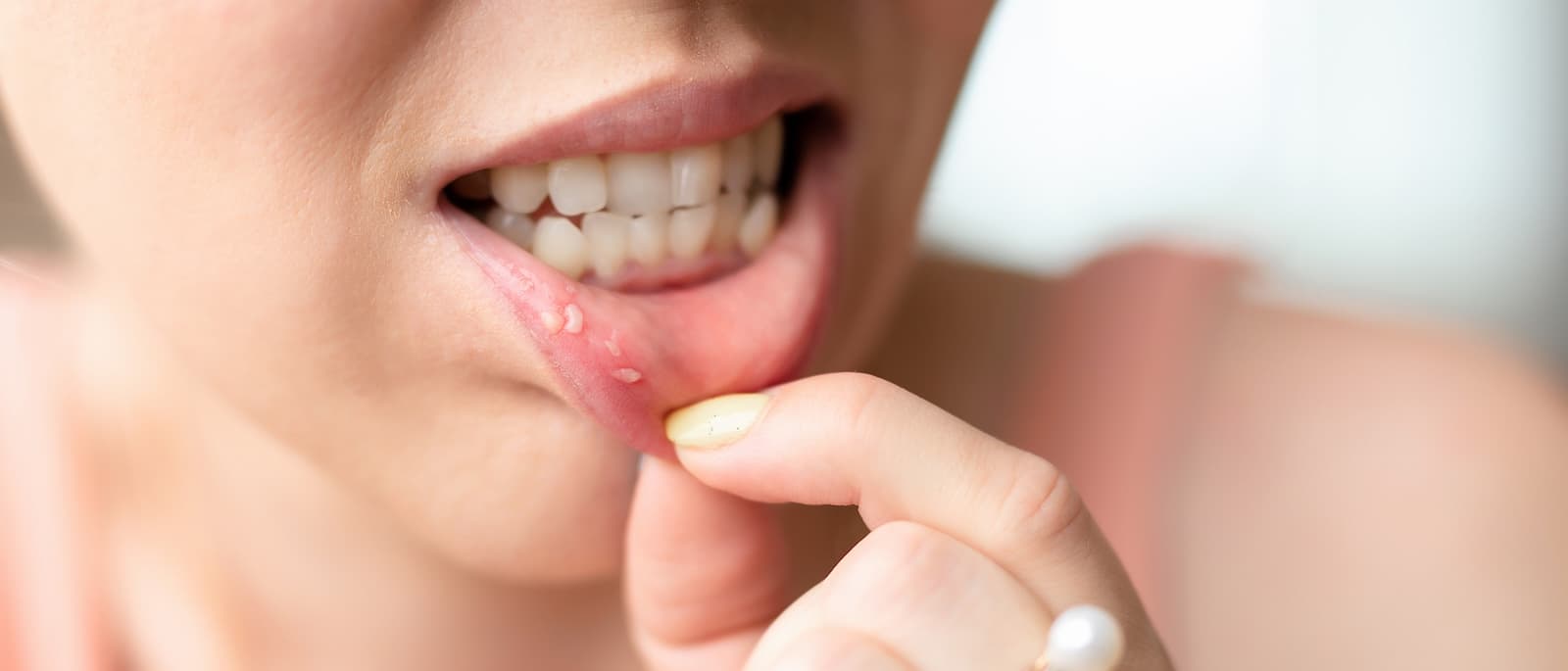 Canker Sore