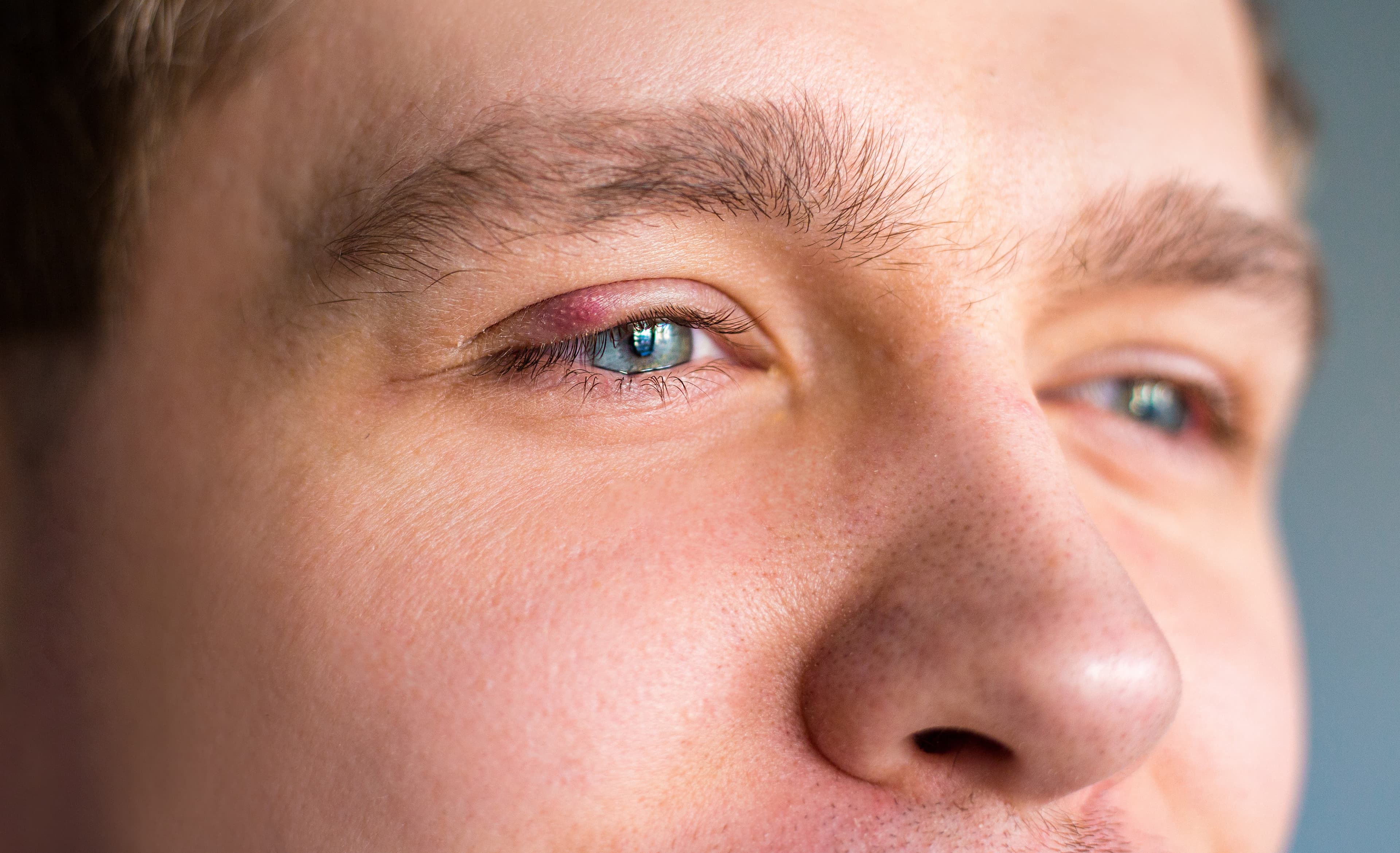Eyelid Inflammation (Blepharitis)