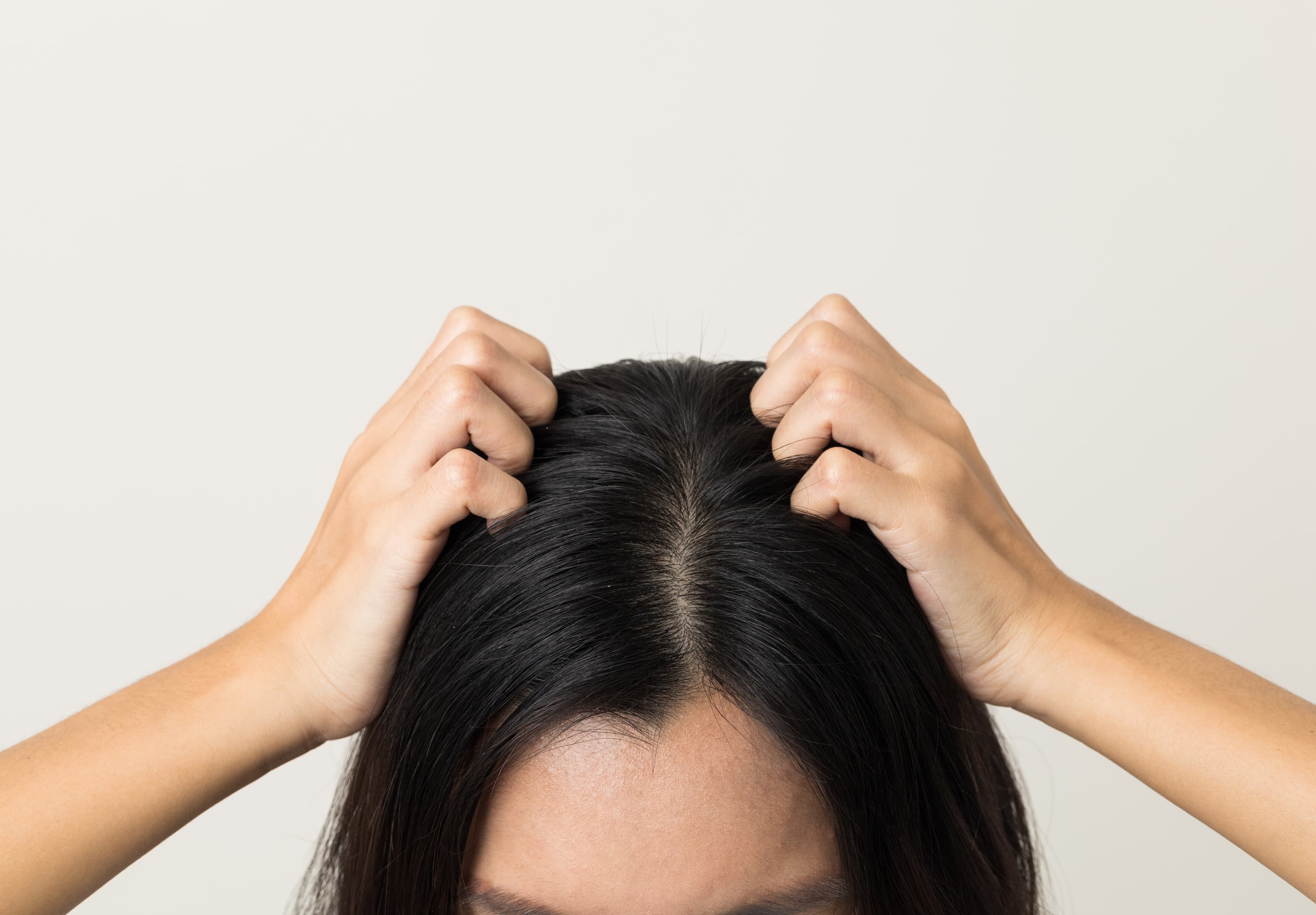 Scalp folliculitis