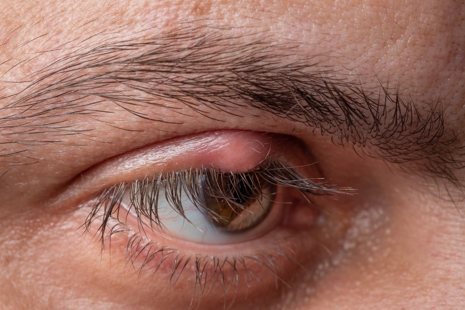 Chalazion
