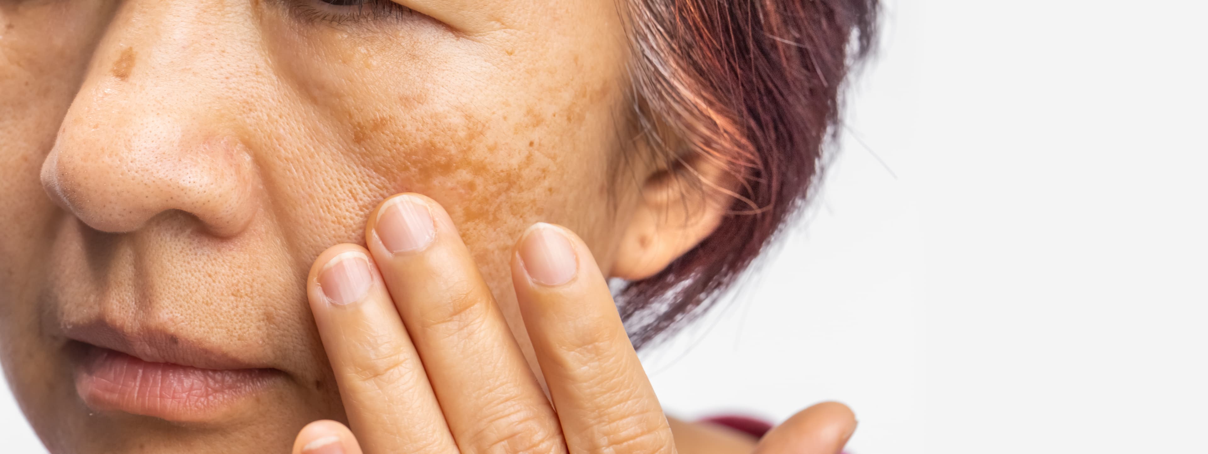 Melasma (Hyperpigmentation)