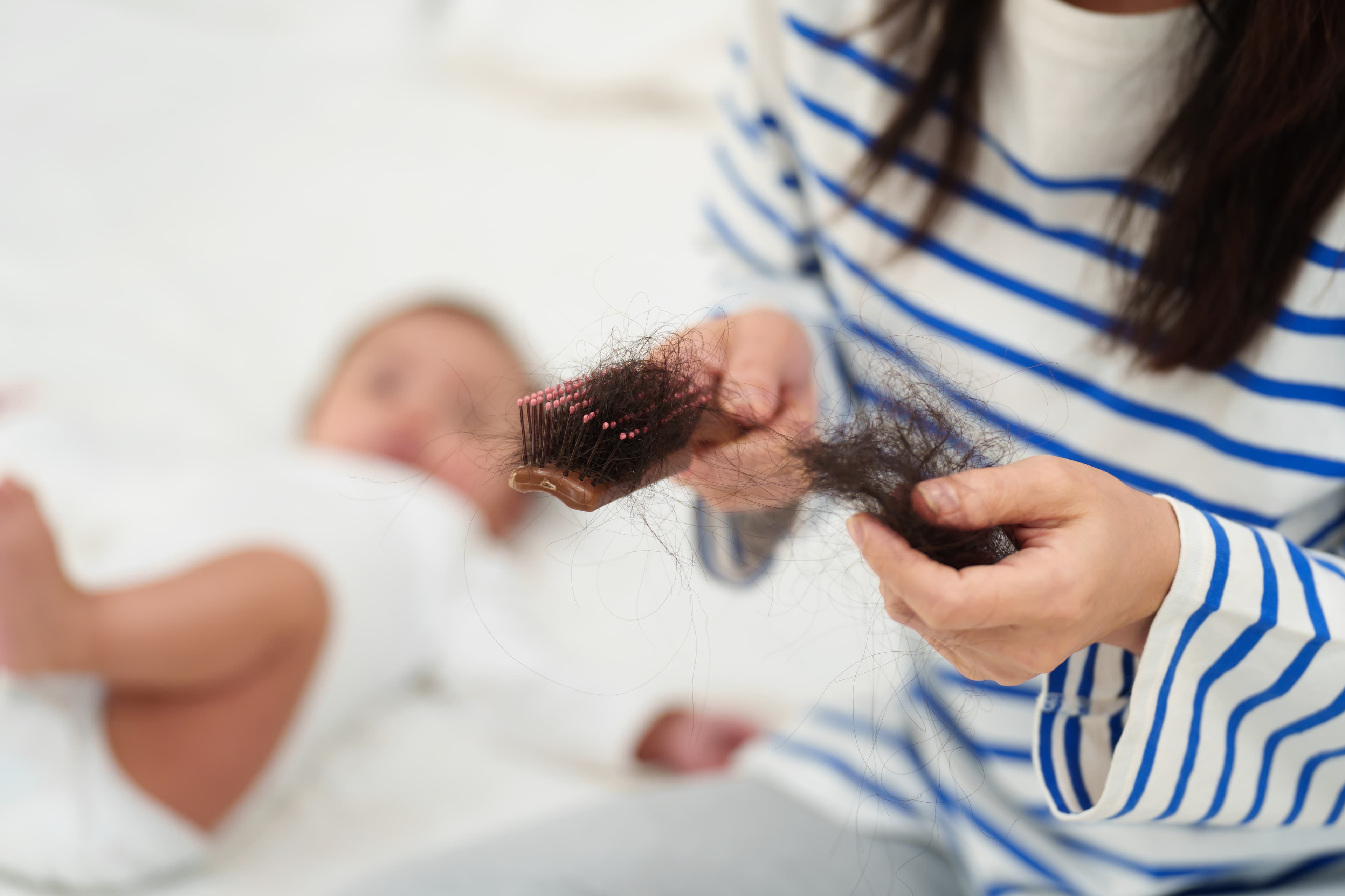 Postpartum Hair Loss