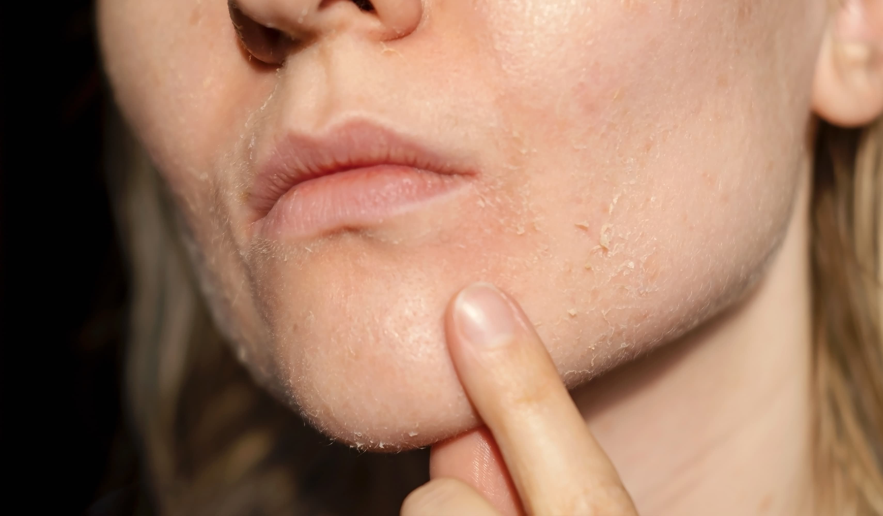 Skin Dryness (Xerosis)