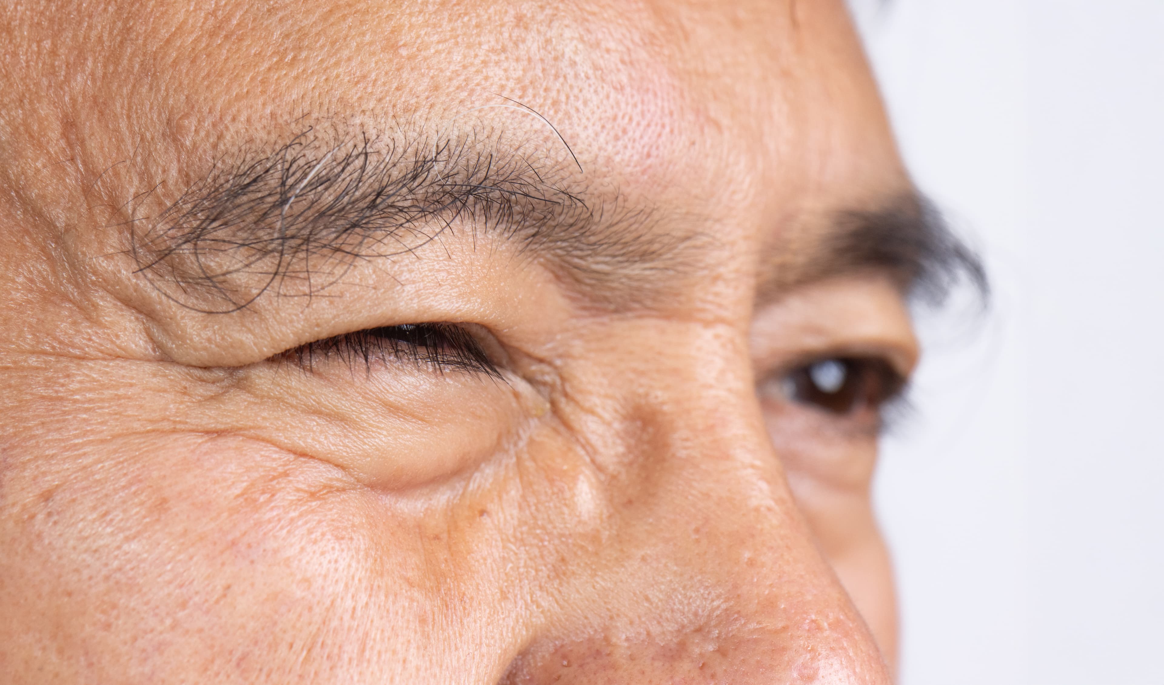 Eyelid Twitching (Myokymia)