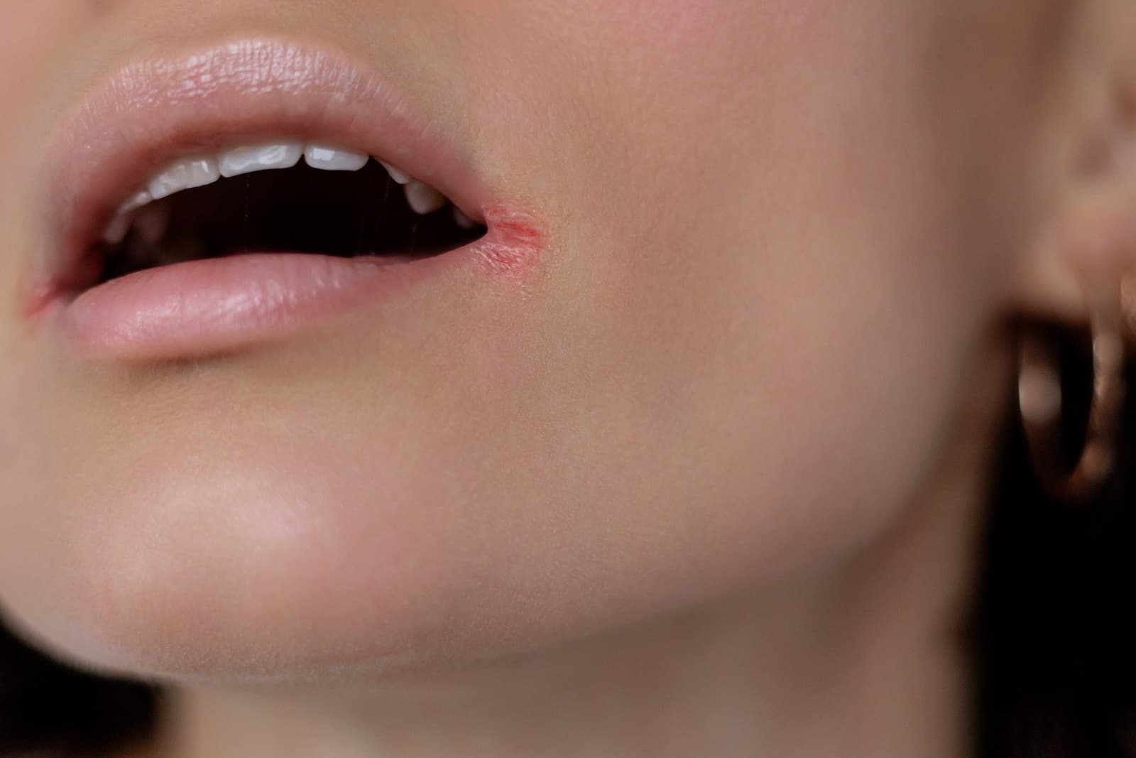Corner of Mouth Cracks (Angular Cheilitis)