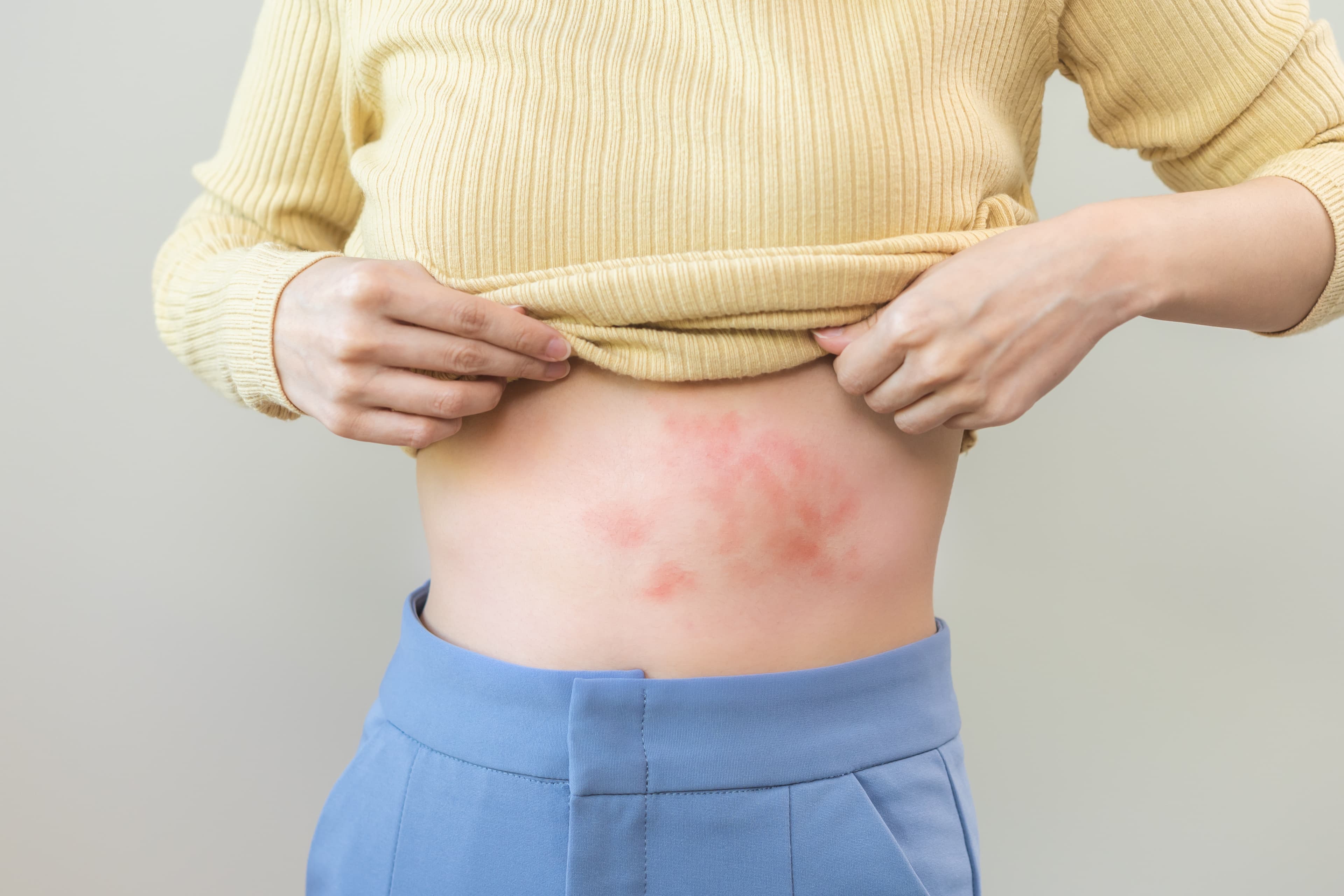 Heat Rash