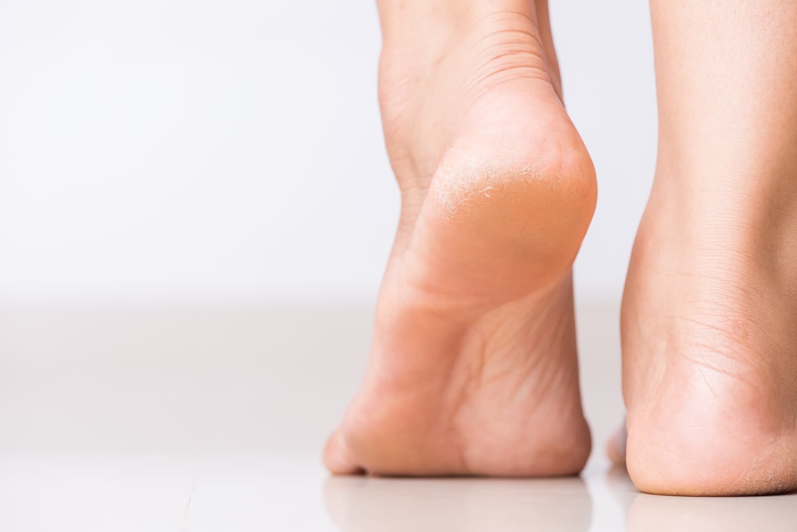 Cracked Heels