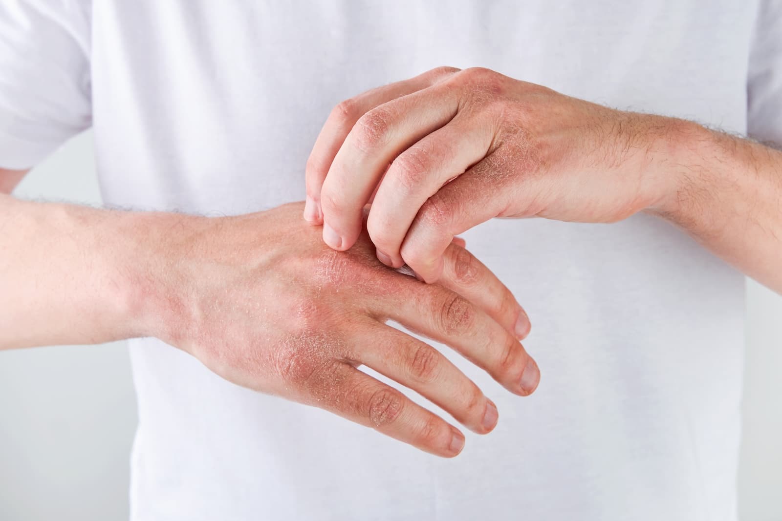 Chronic dryness or cracking of hands