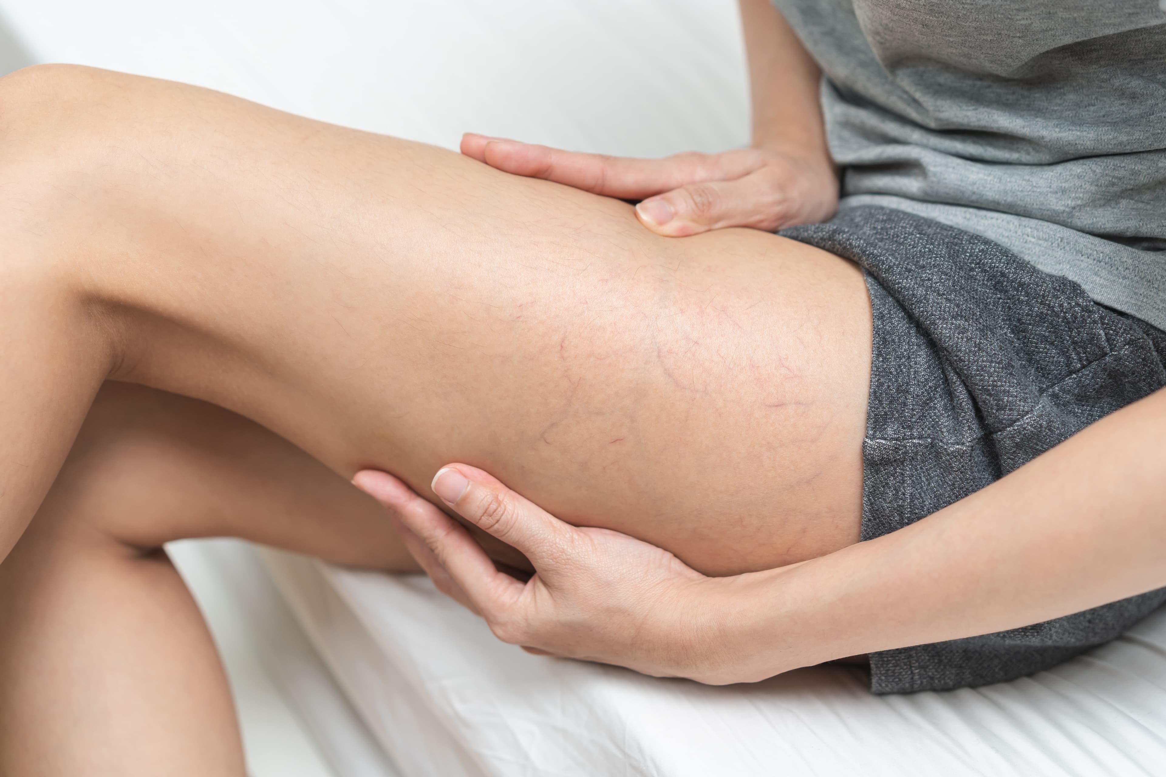 Varicose Veins Consult