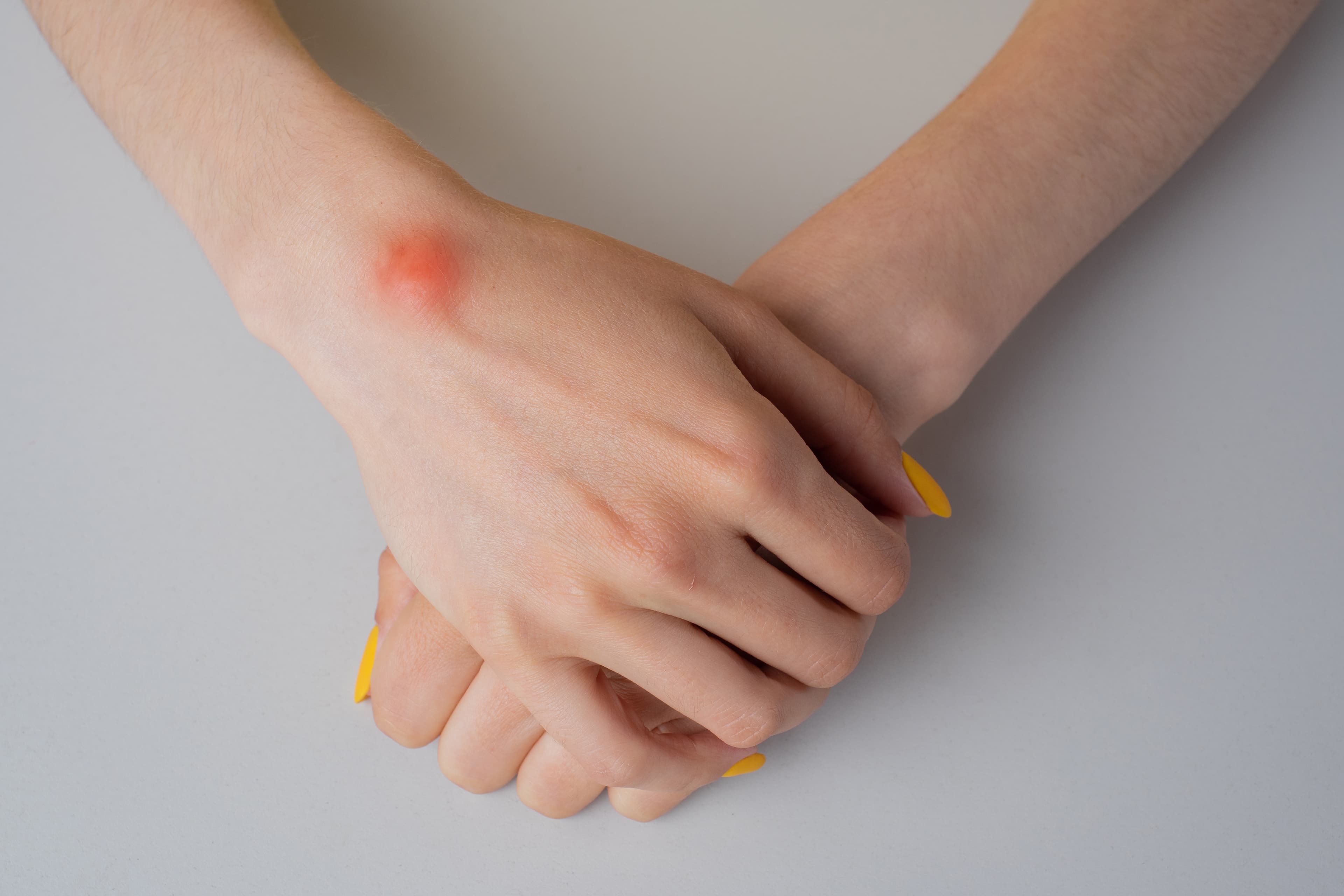 Epidermoid Cyst / Sebaceous Cyst