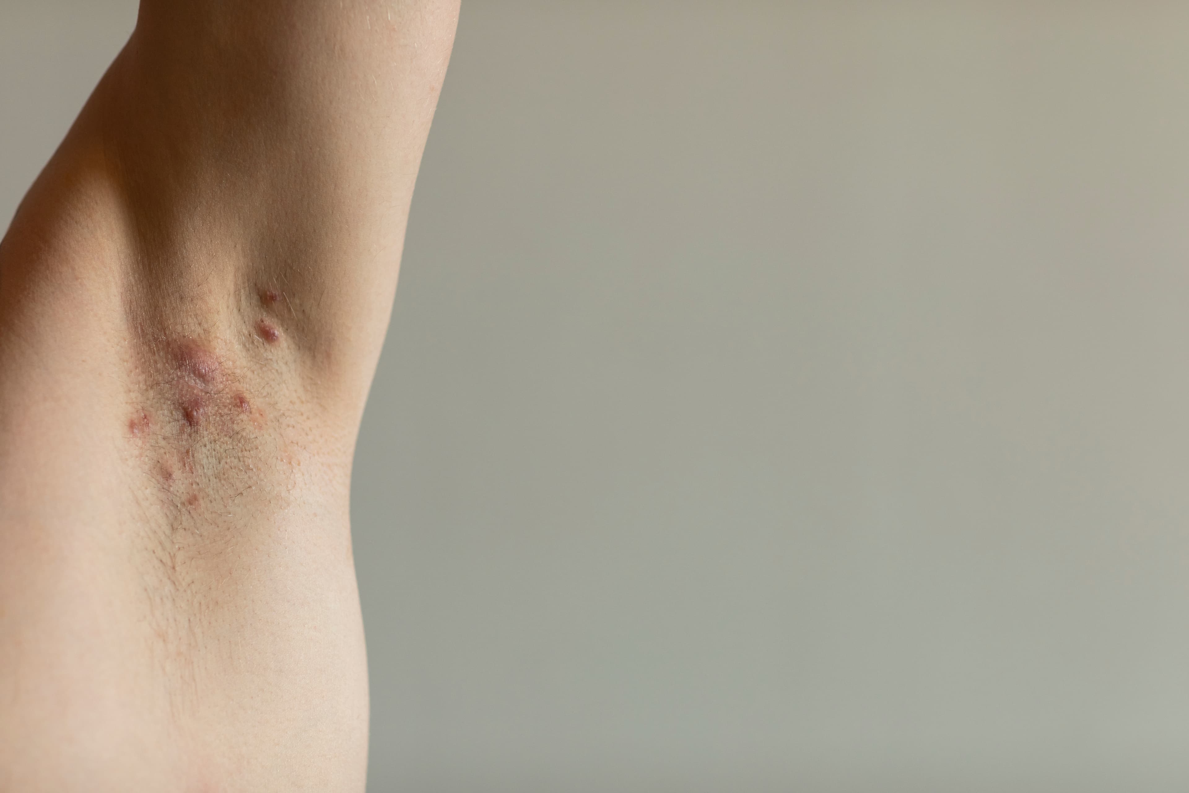 Hidradenitis Suppurativa