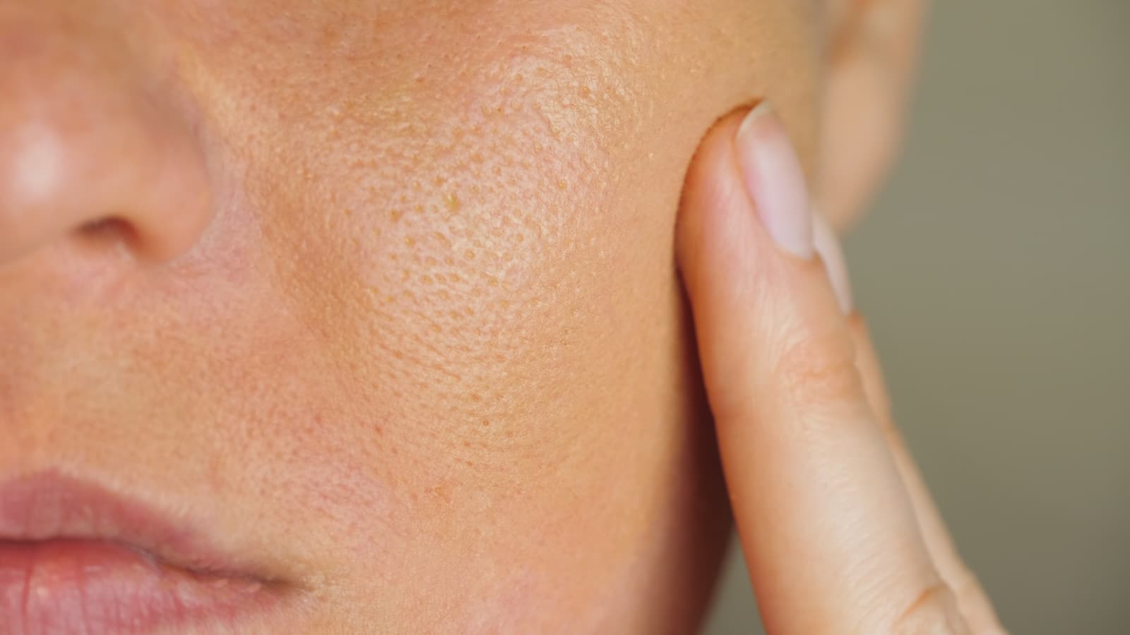 Clogged Pores