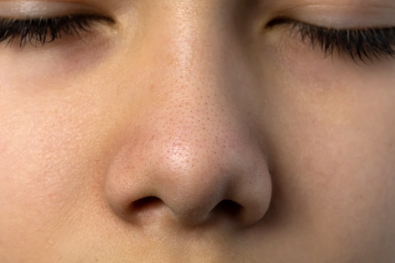 Blackheads (Comedones)