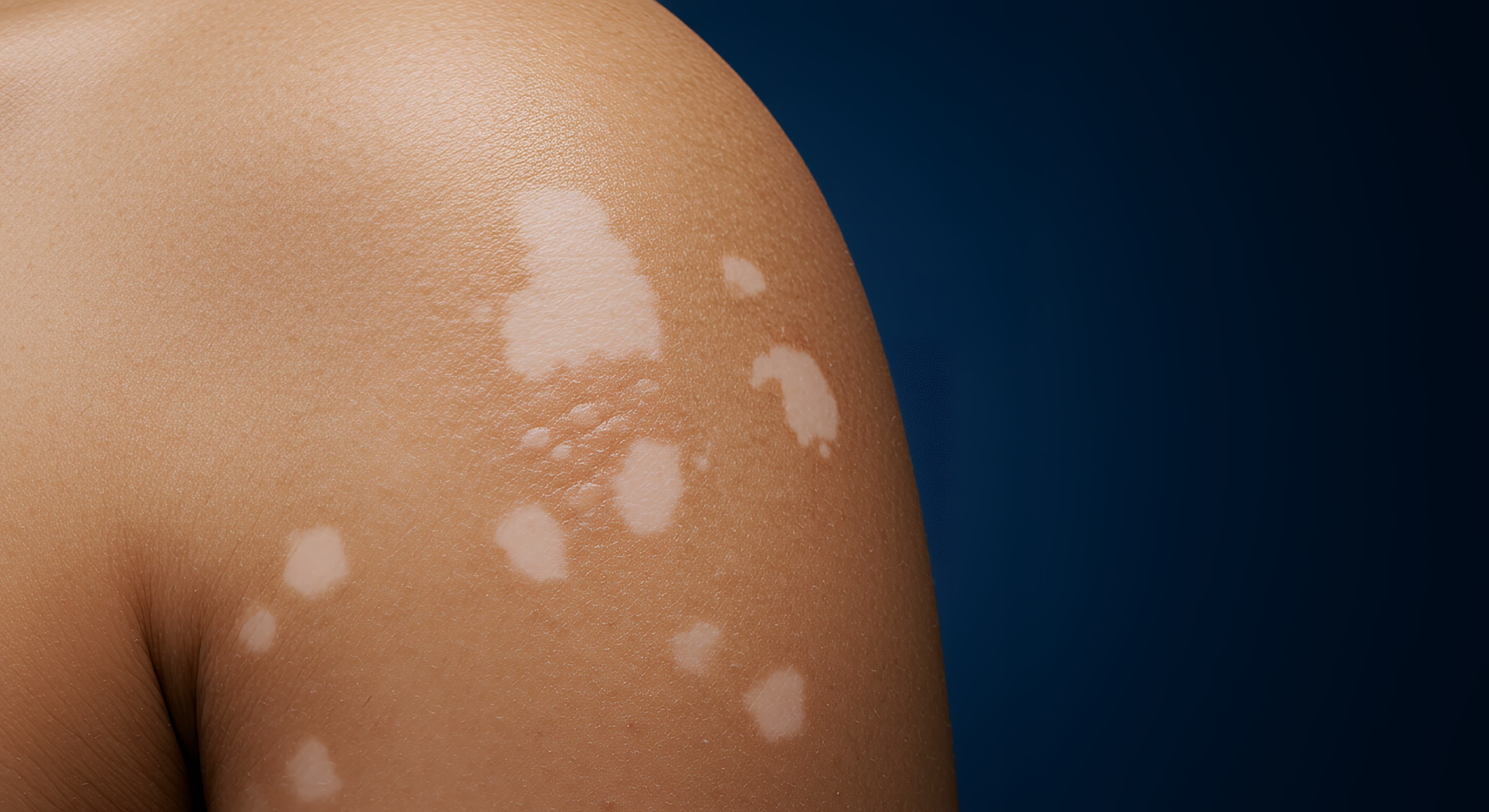 Light Patches on Skin