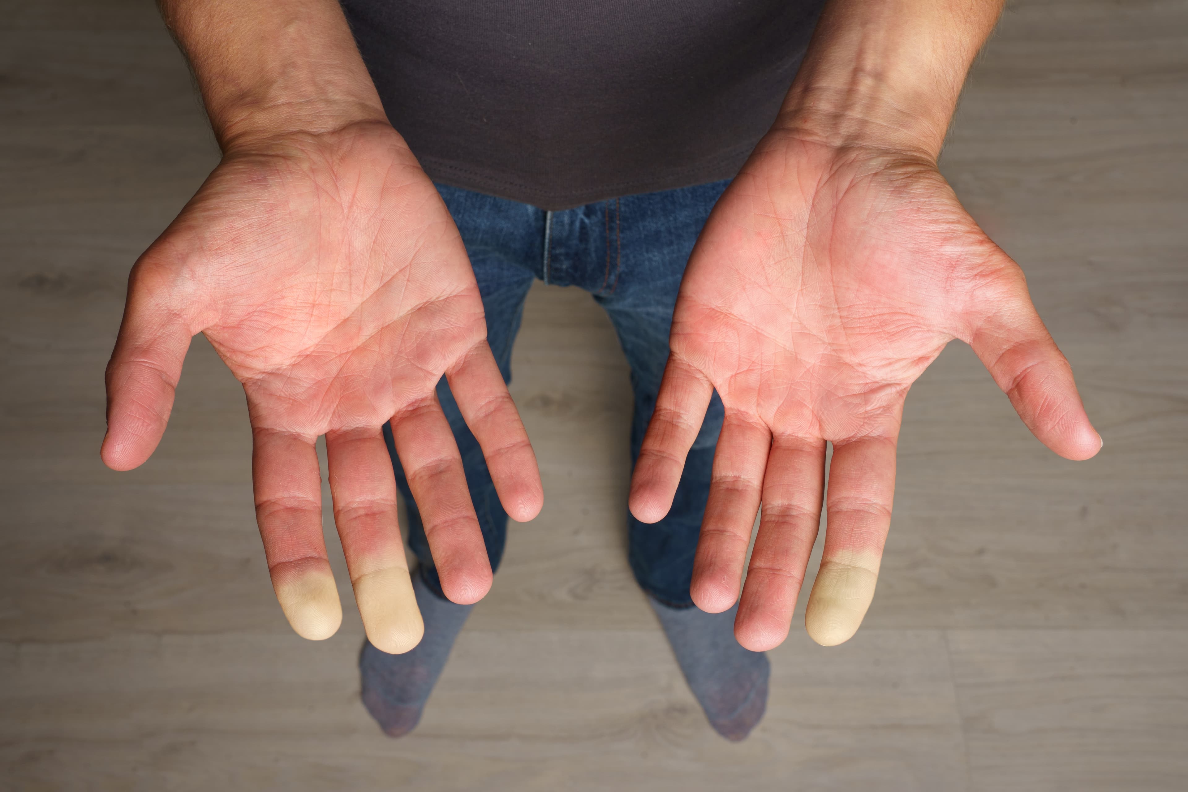 Raynaud's syndrome
