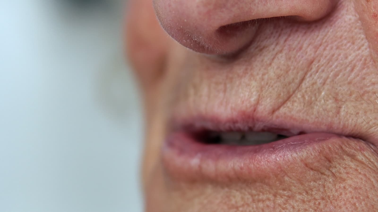 Dry Mouth (Xerostomia)