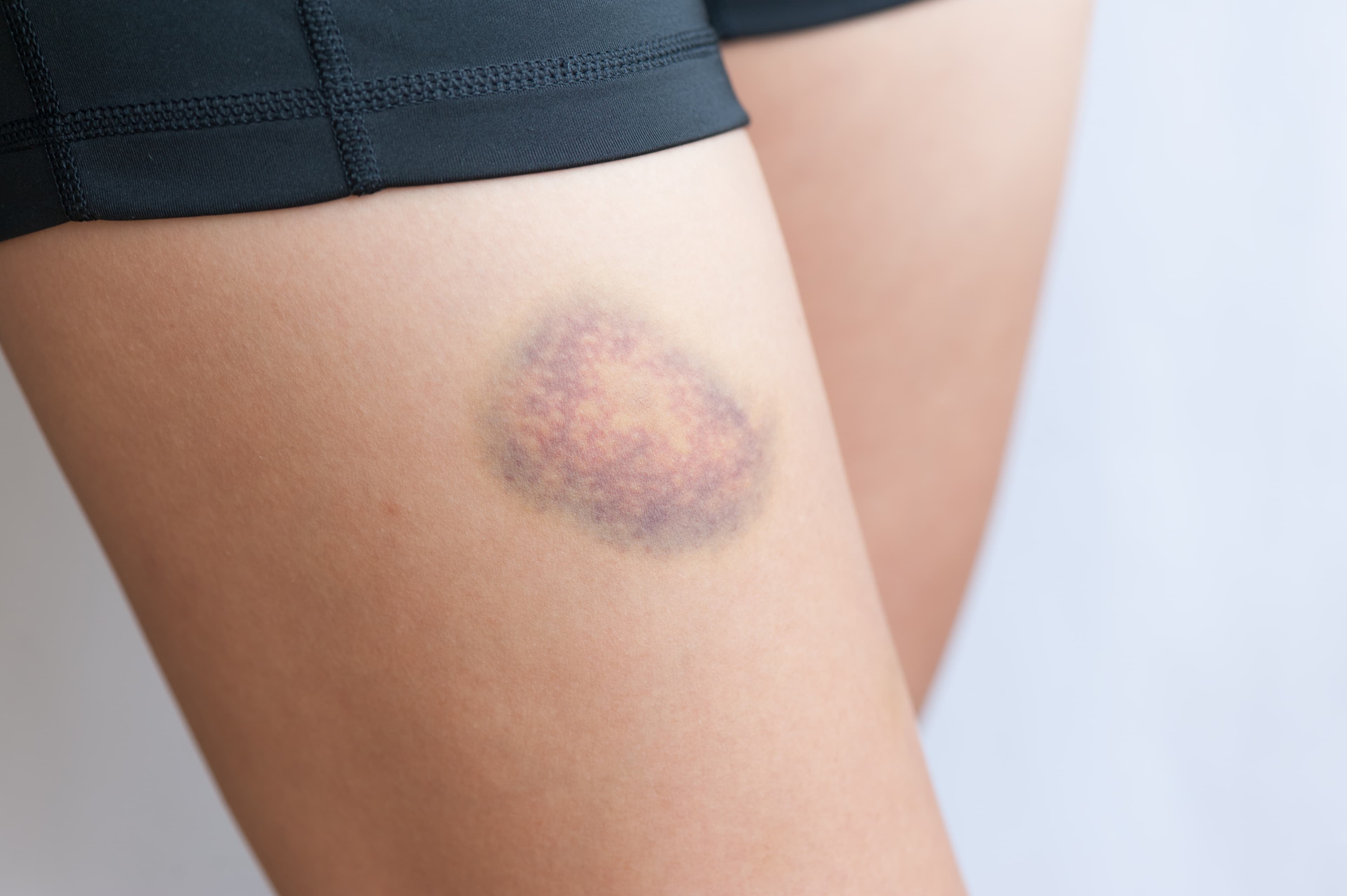 Bruising Easily (Mild Ecchymosis)