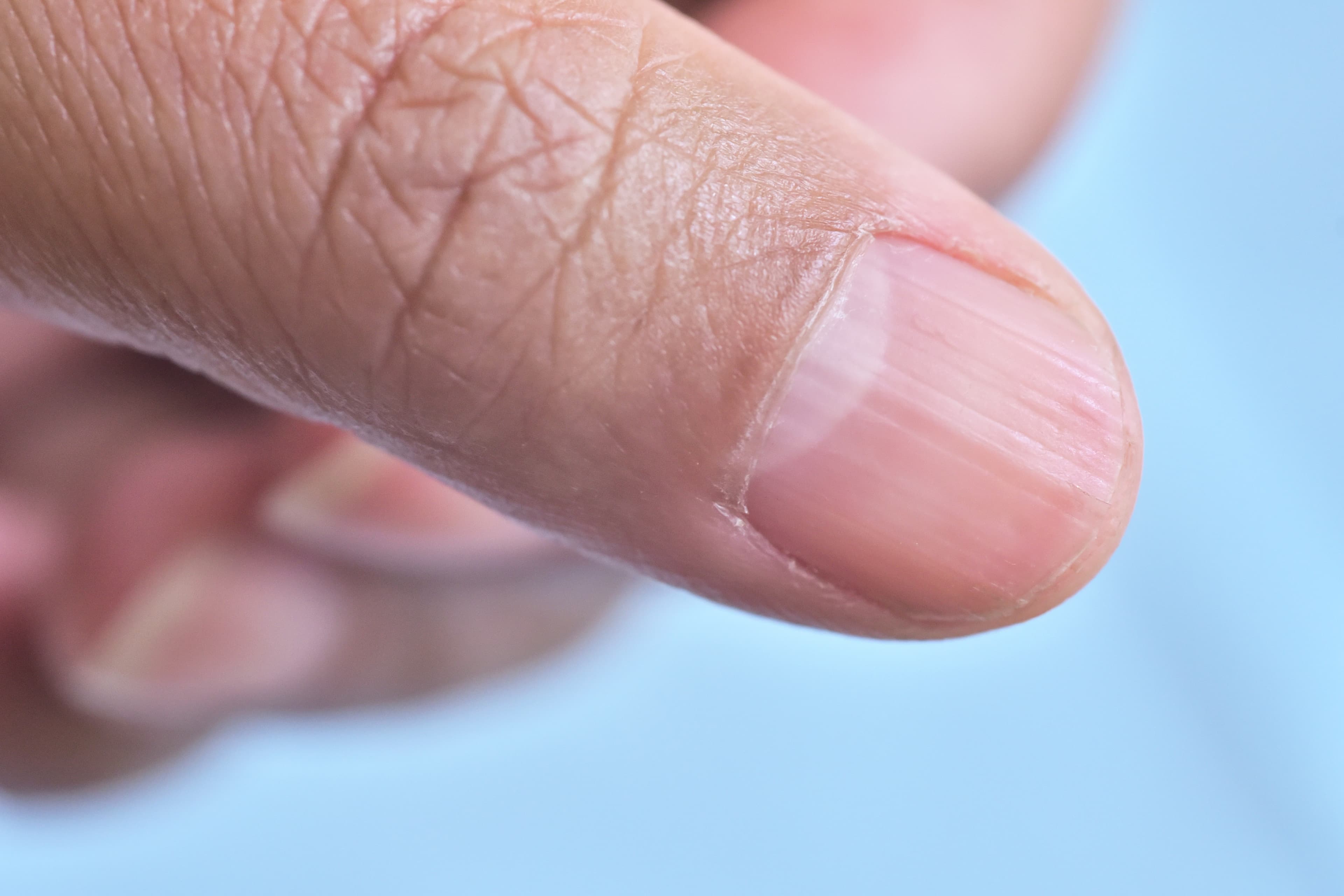 Nail Ridges