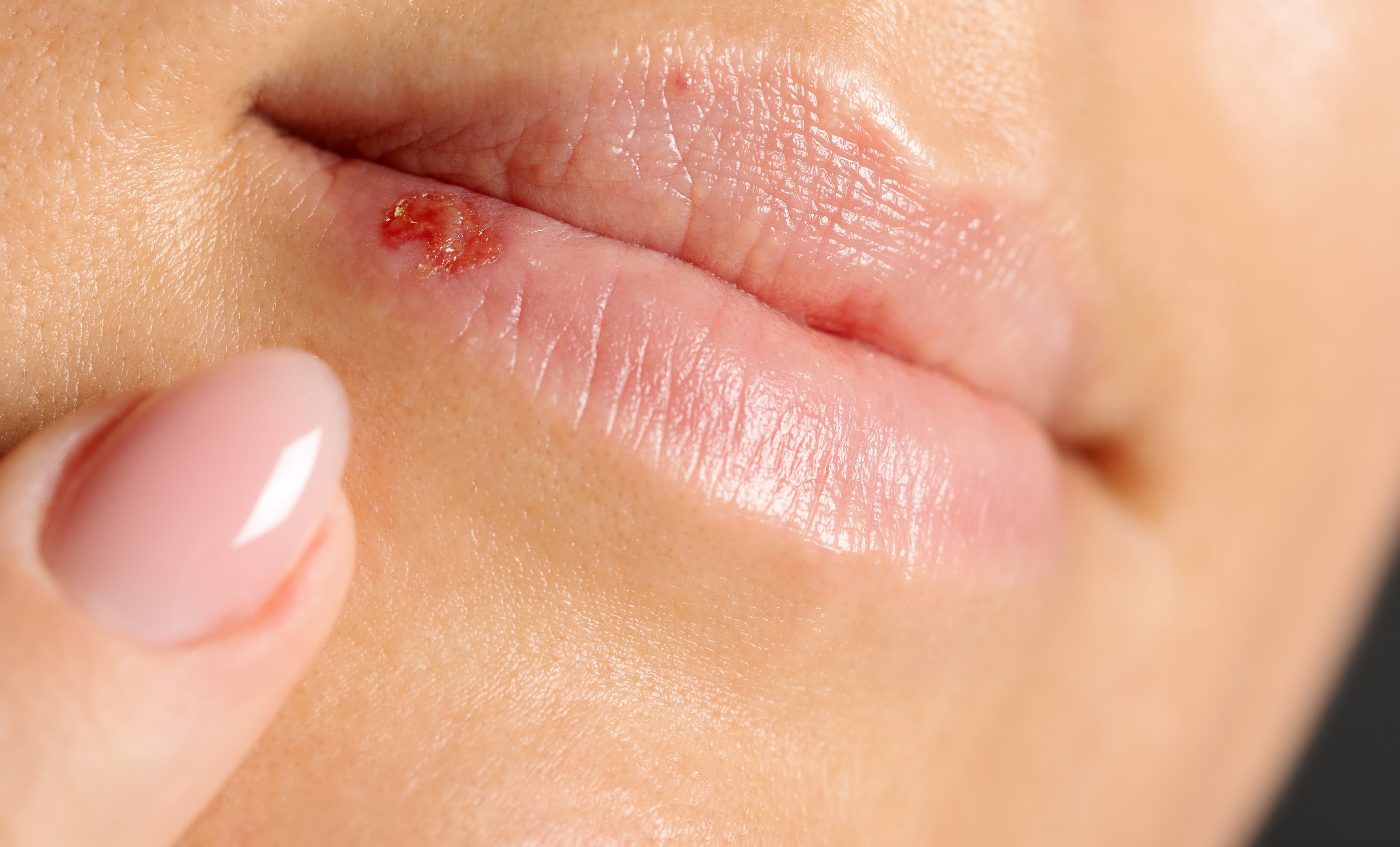Herpes Labialis
