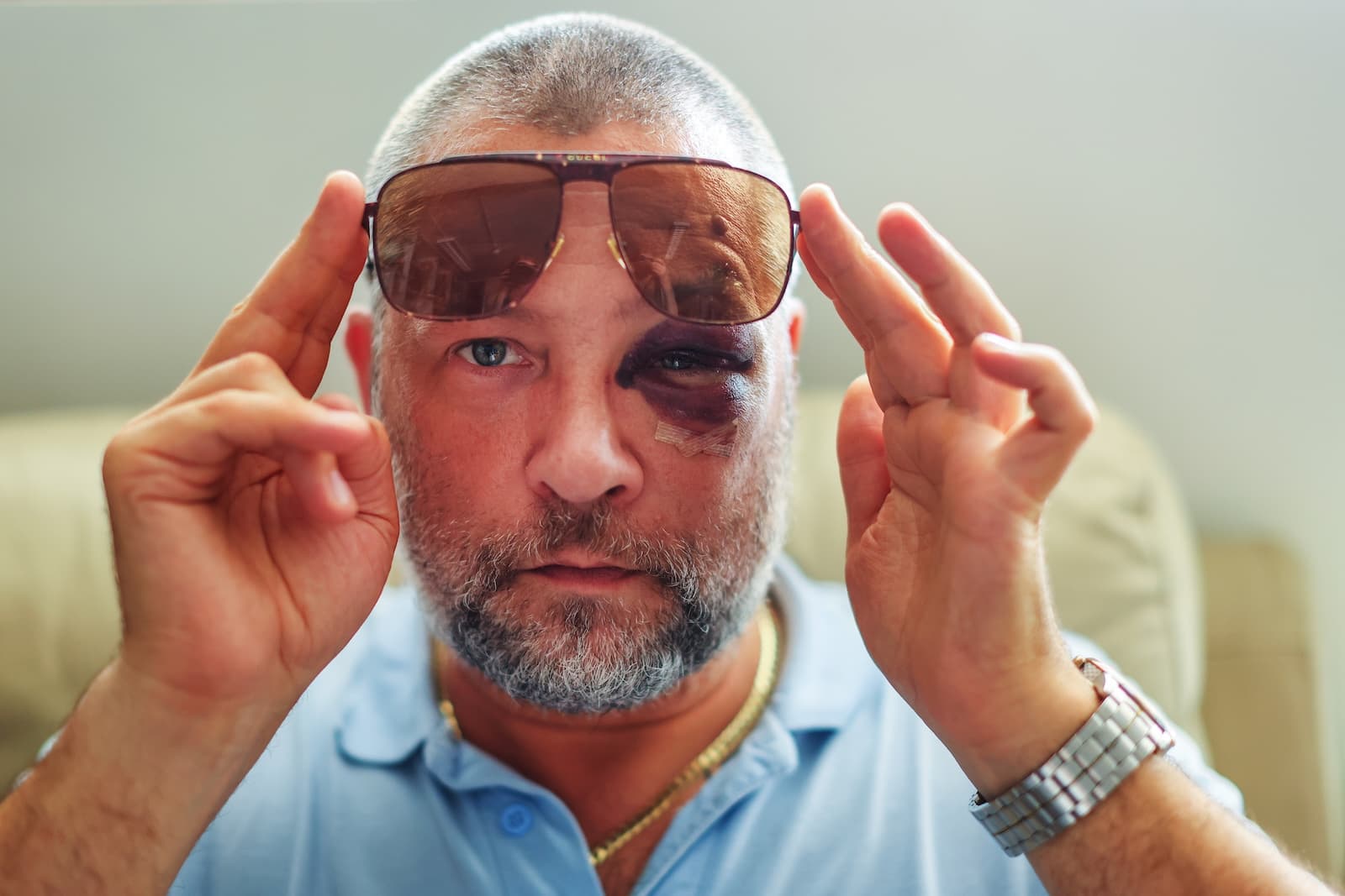Black eye