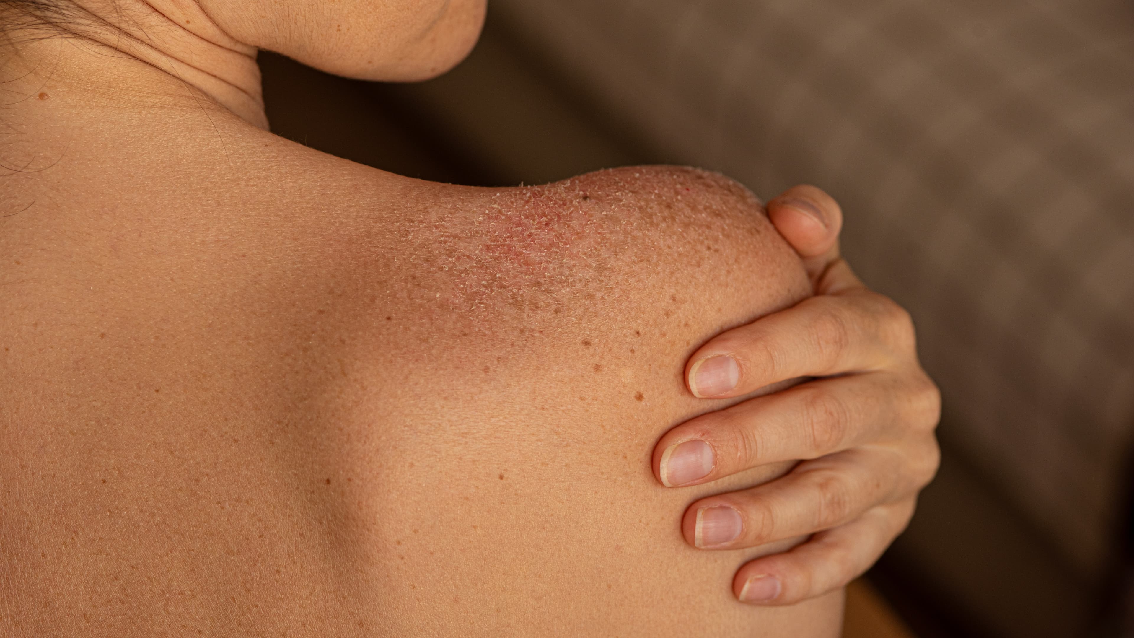 Skin ulcer