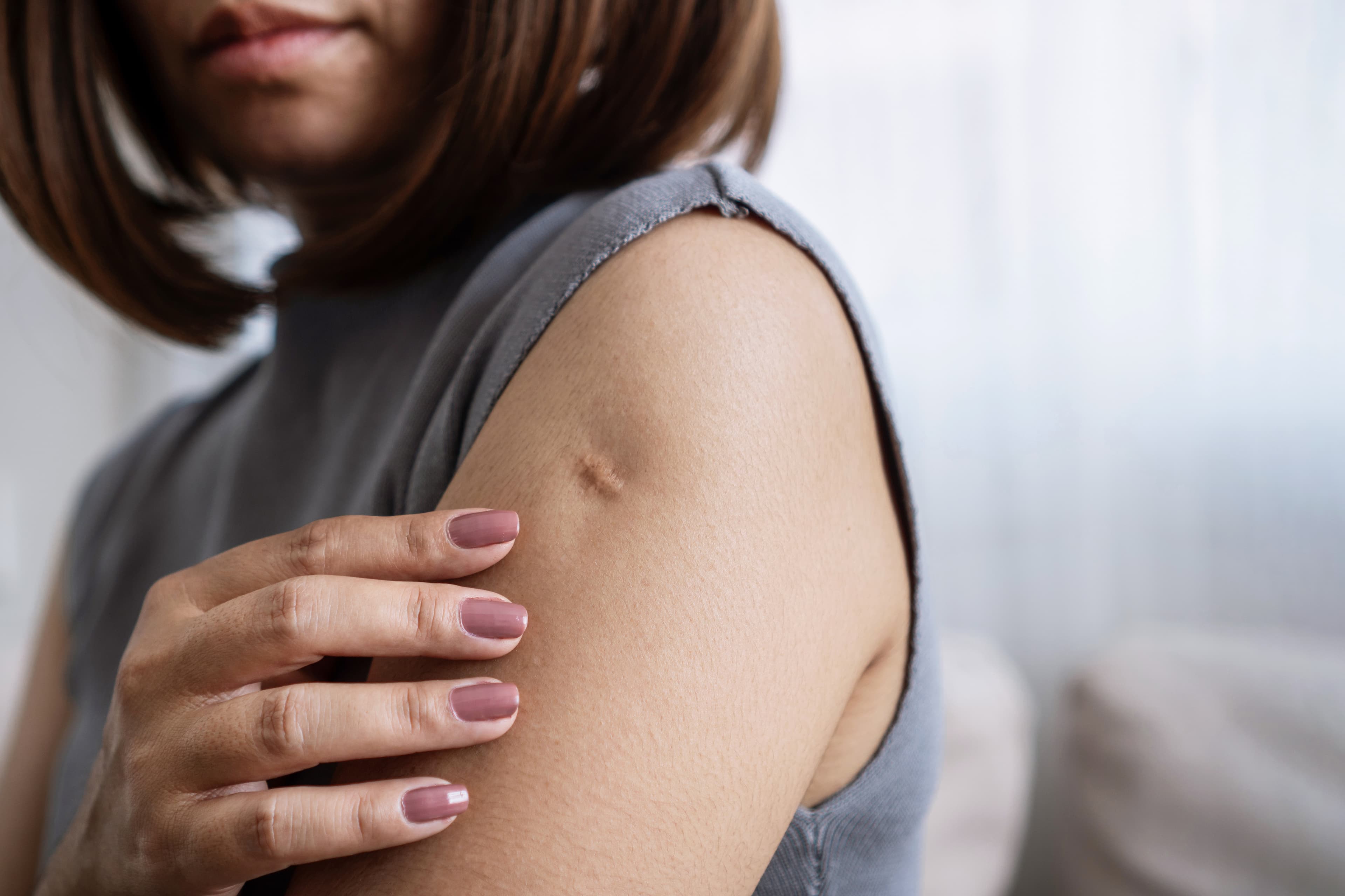Scar appearance
