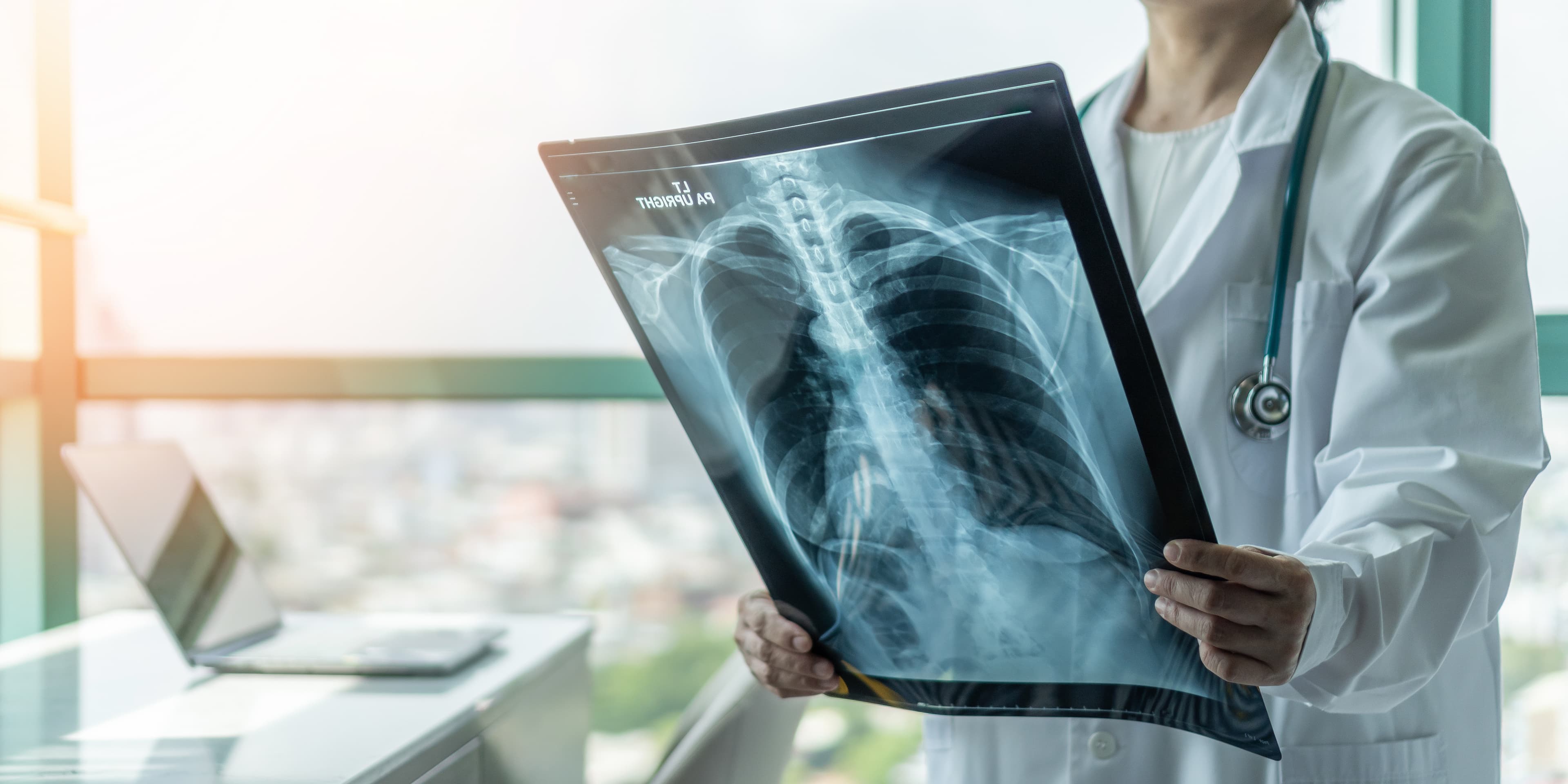 Mesothelioma screening