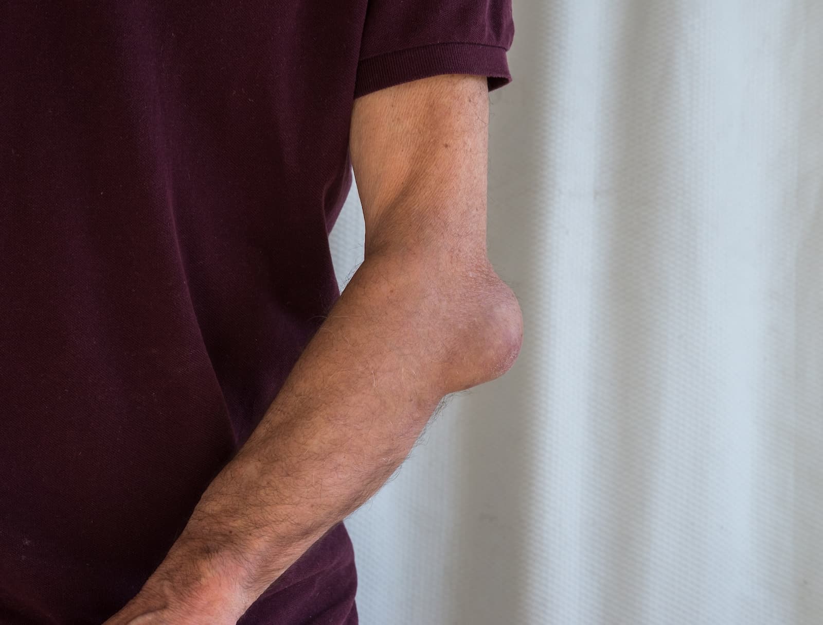 bursitis