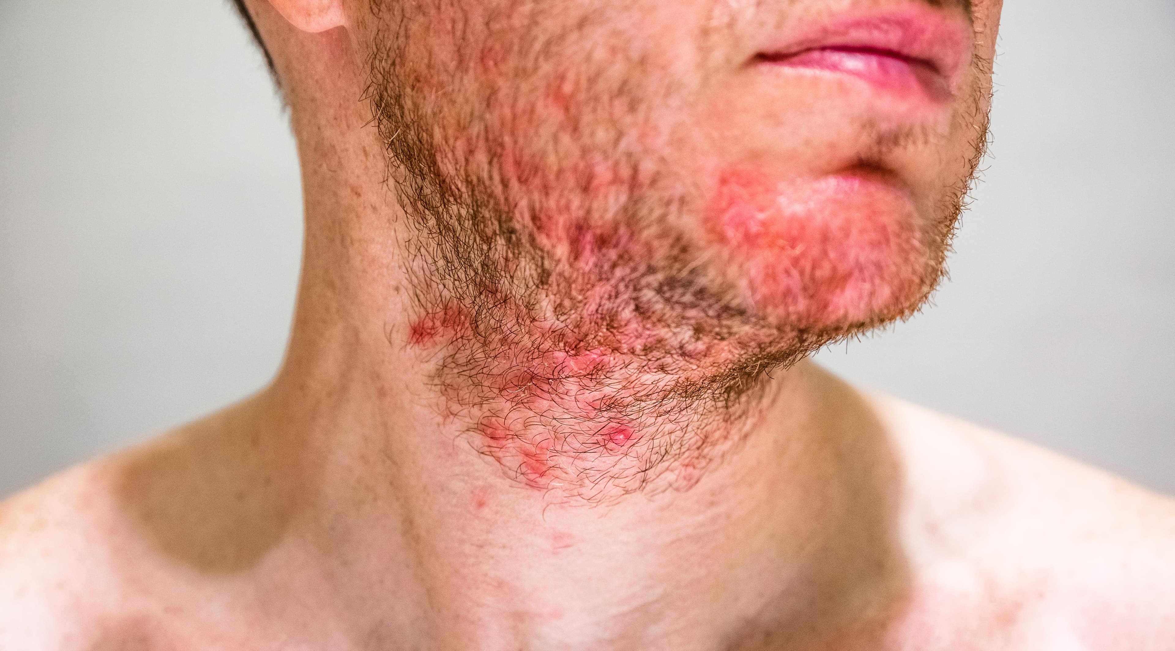Folliculitis