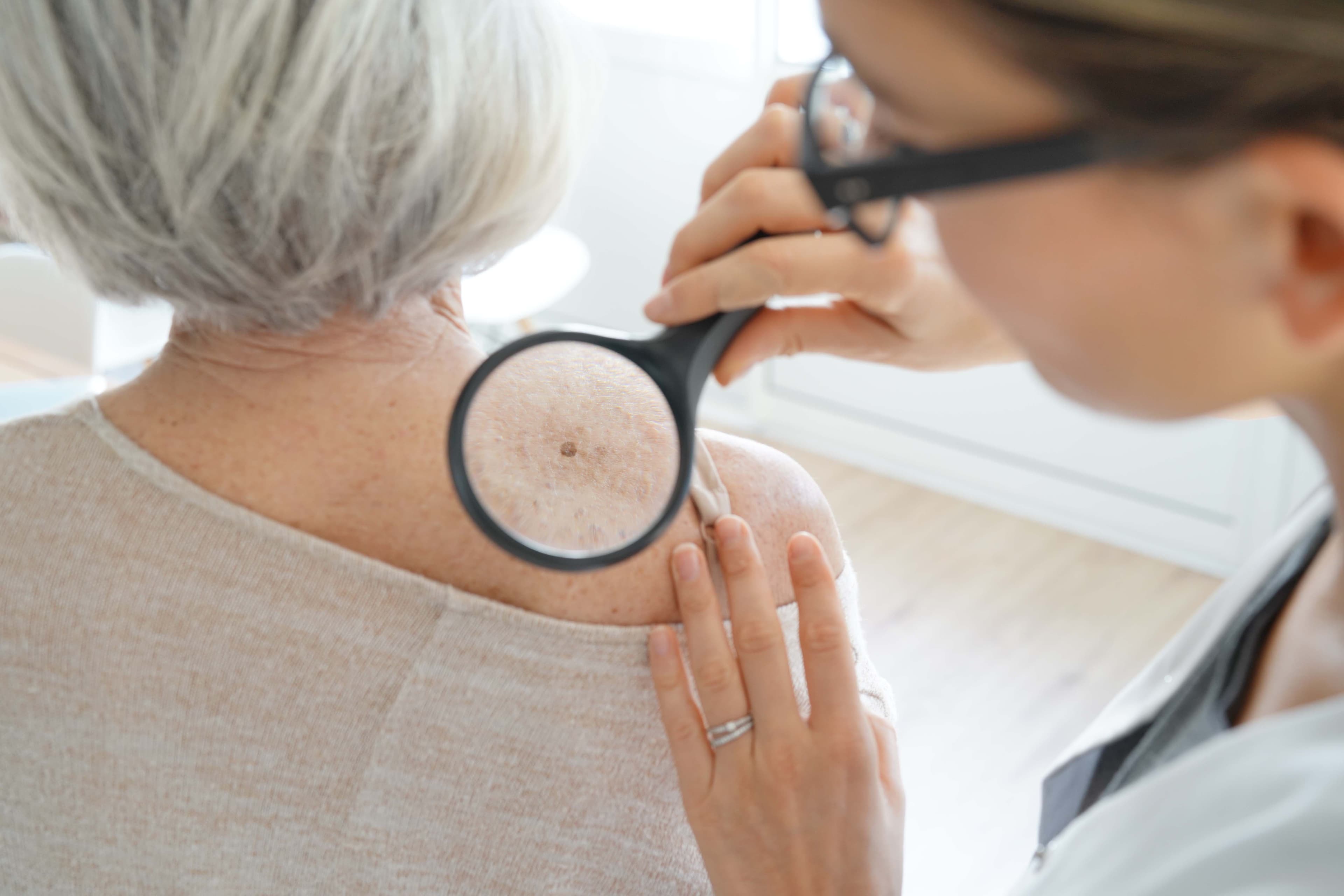 Get a mole checked