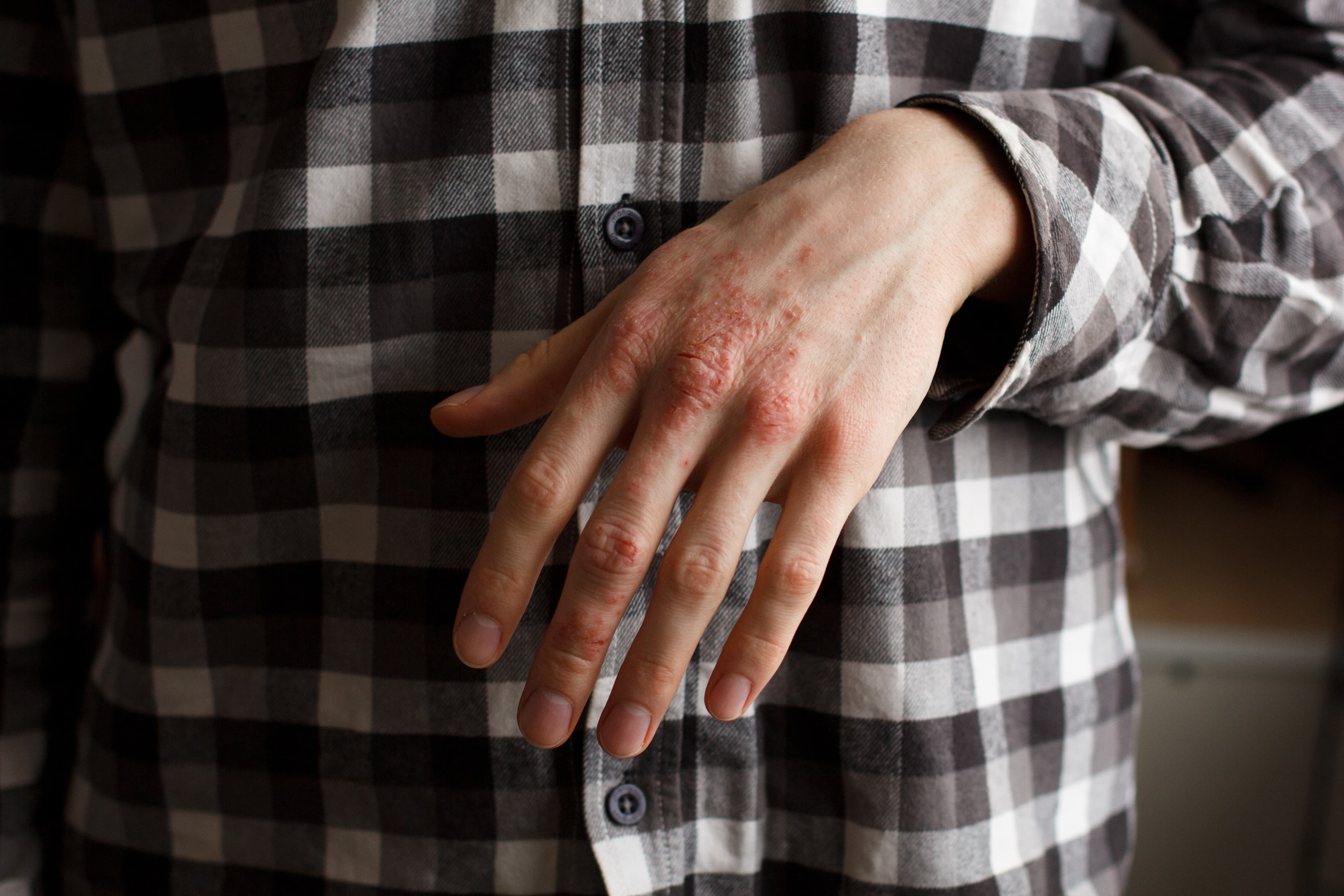 Guttate psoriasis