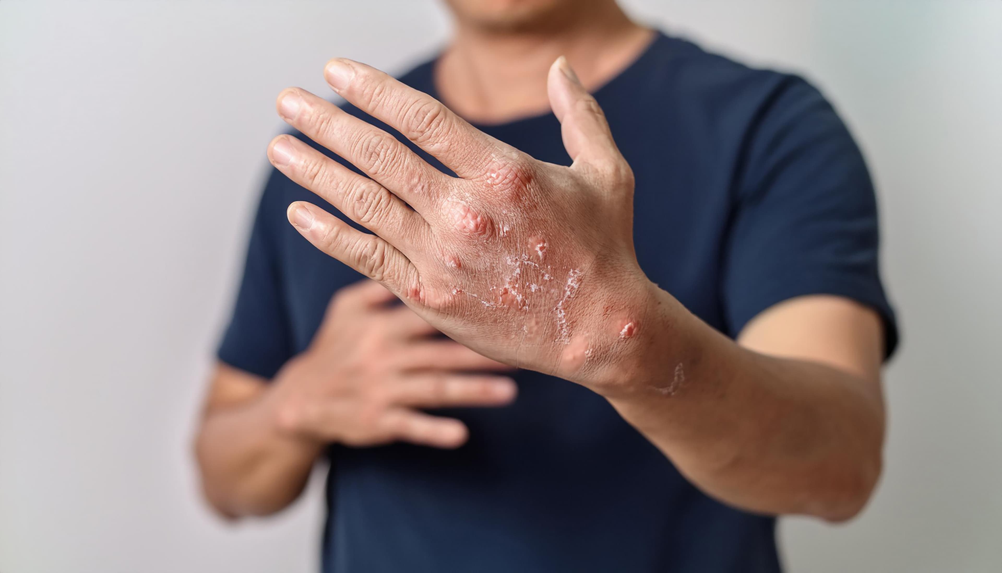 Nummular eczema