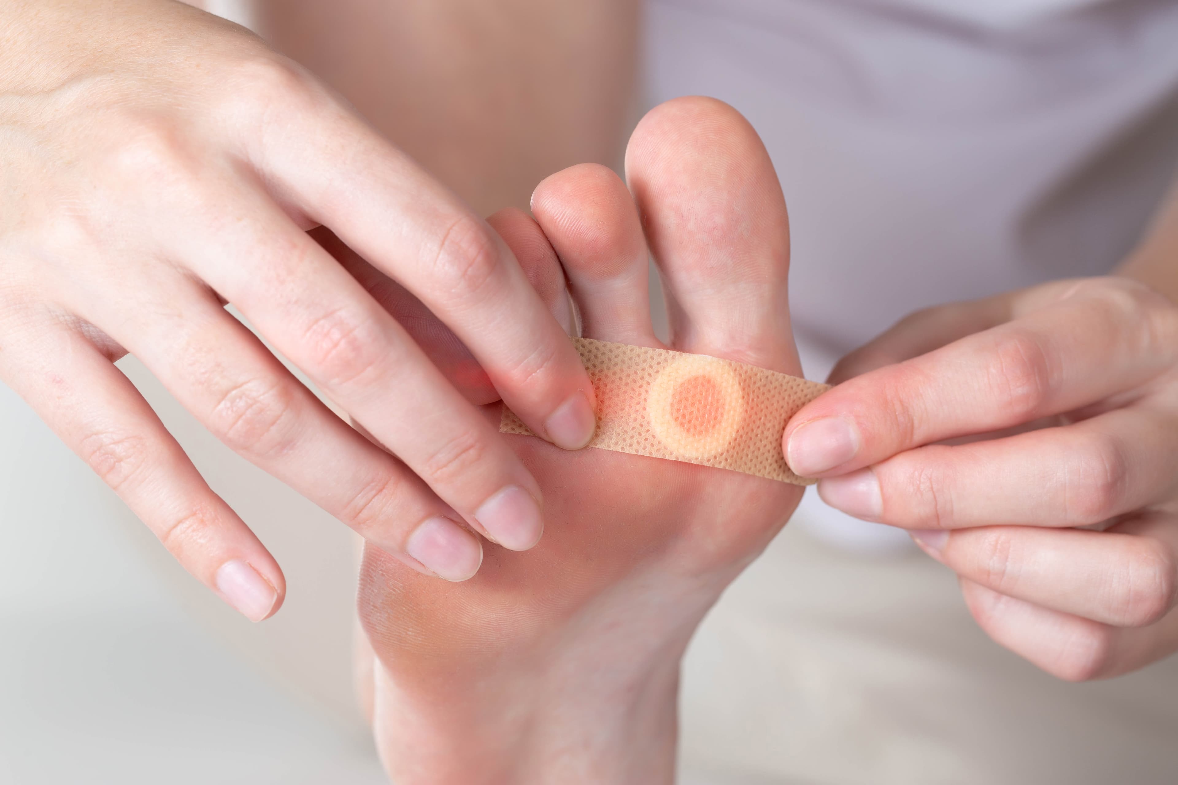 Warts