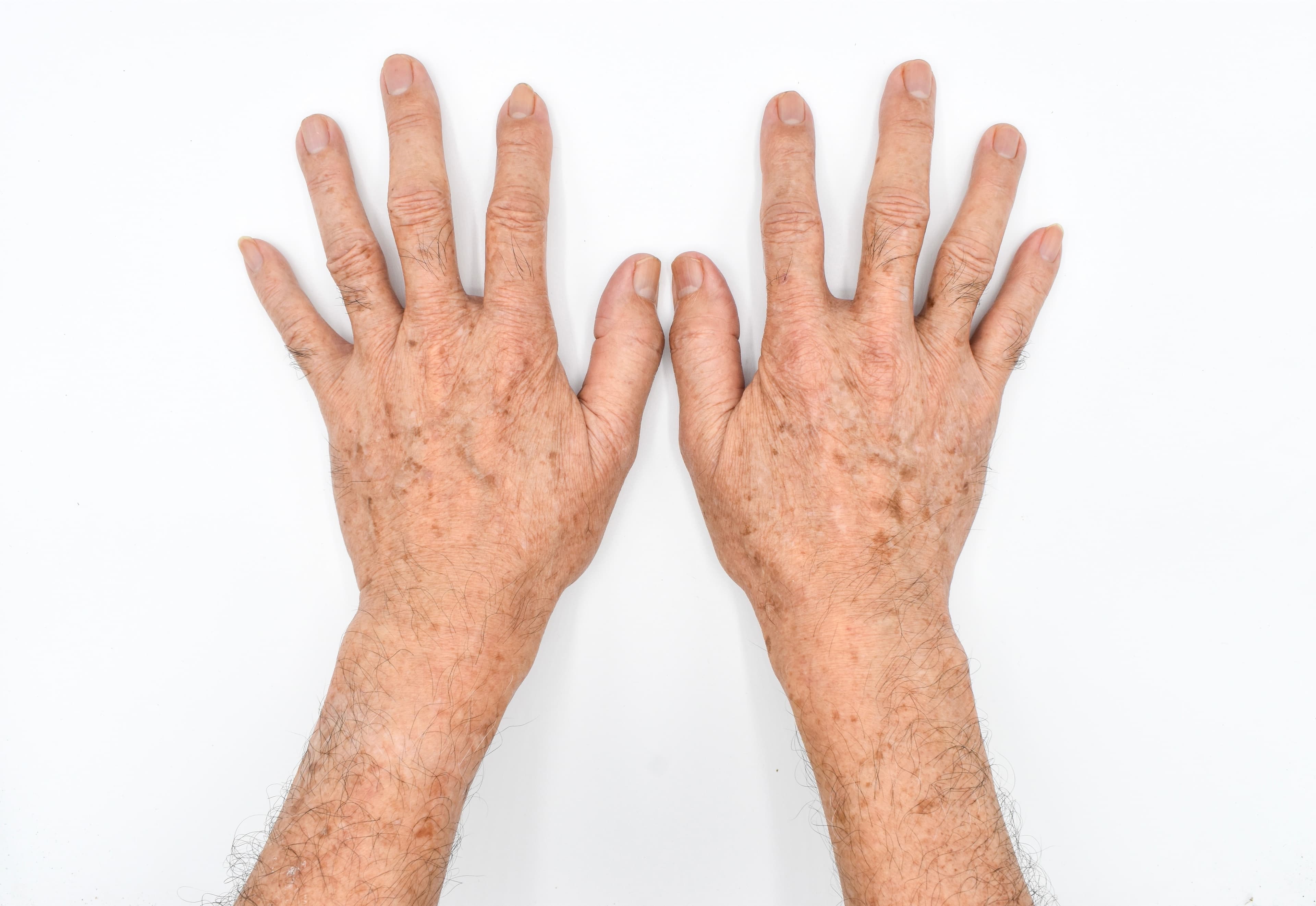 Actinic keratosis