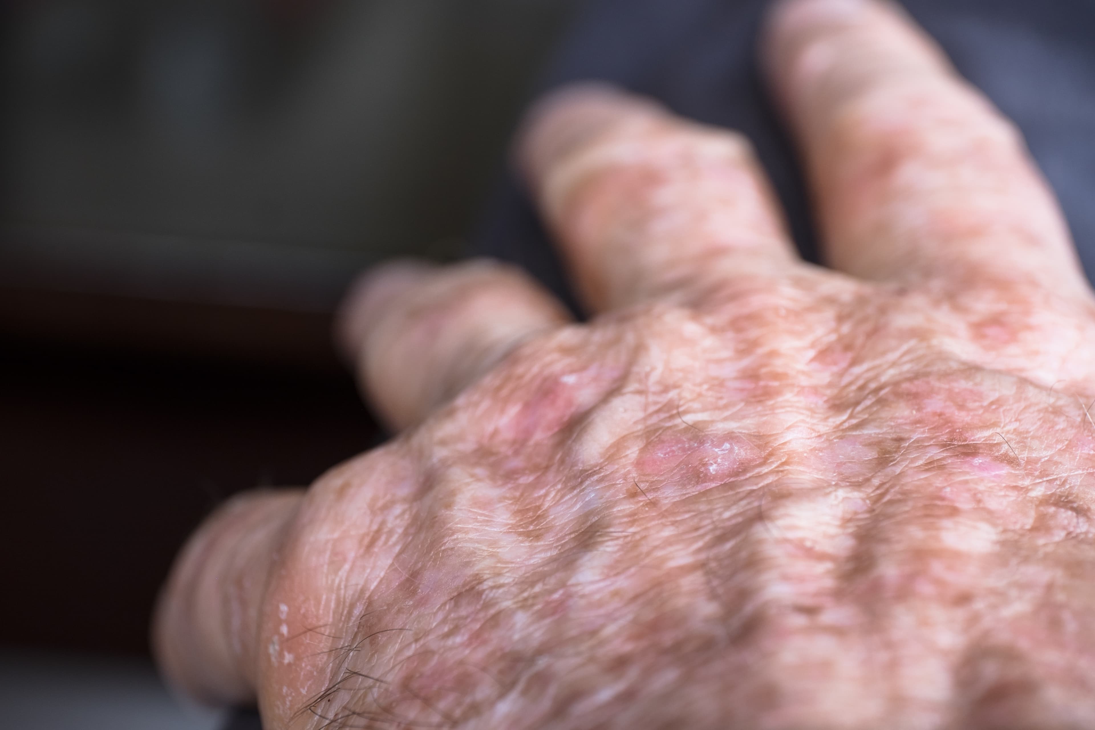 Actinic keratosis