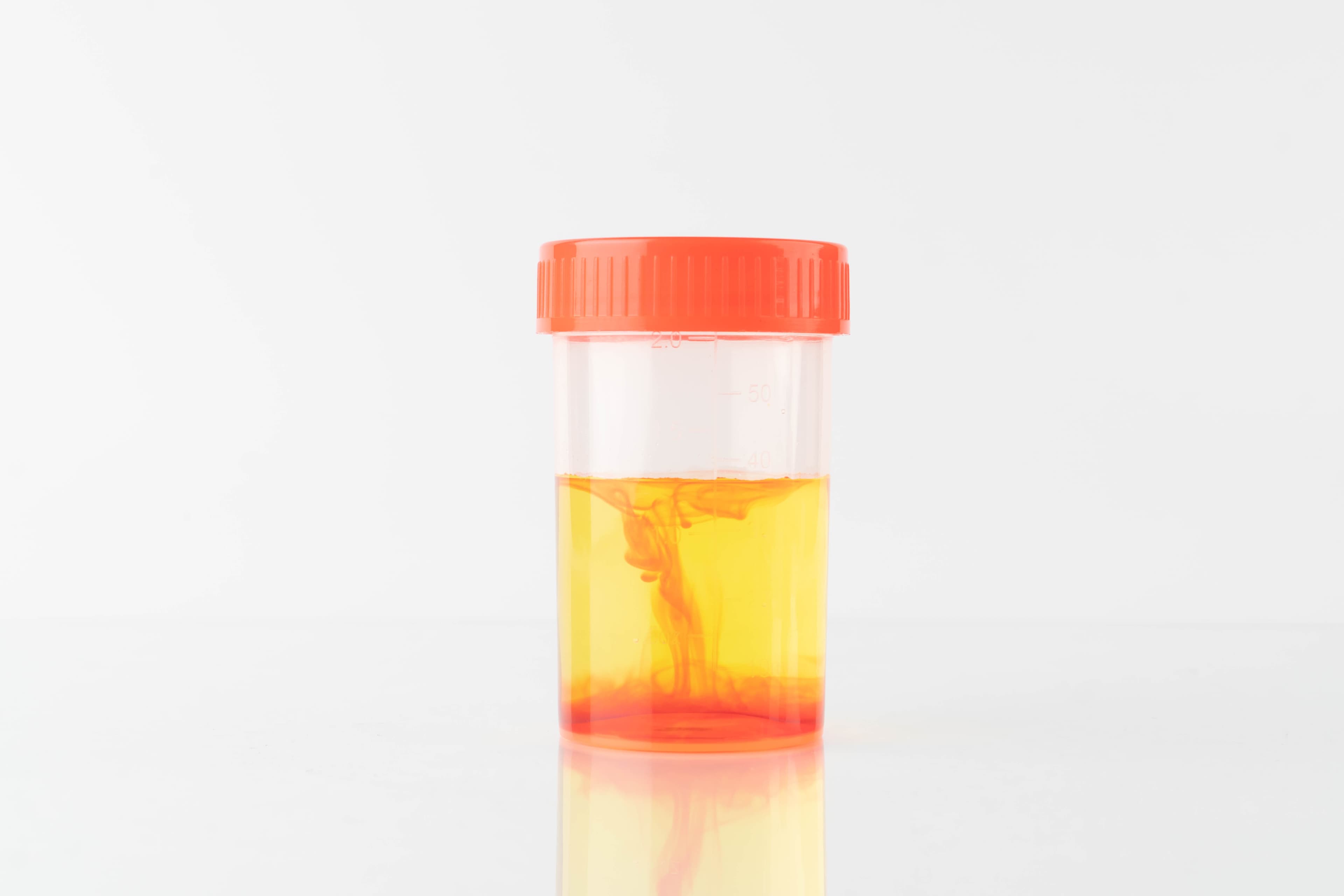Hematuria (blood in urine)