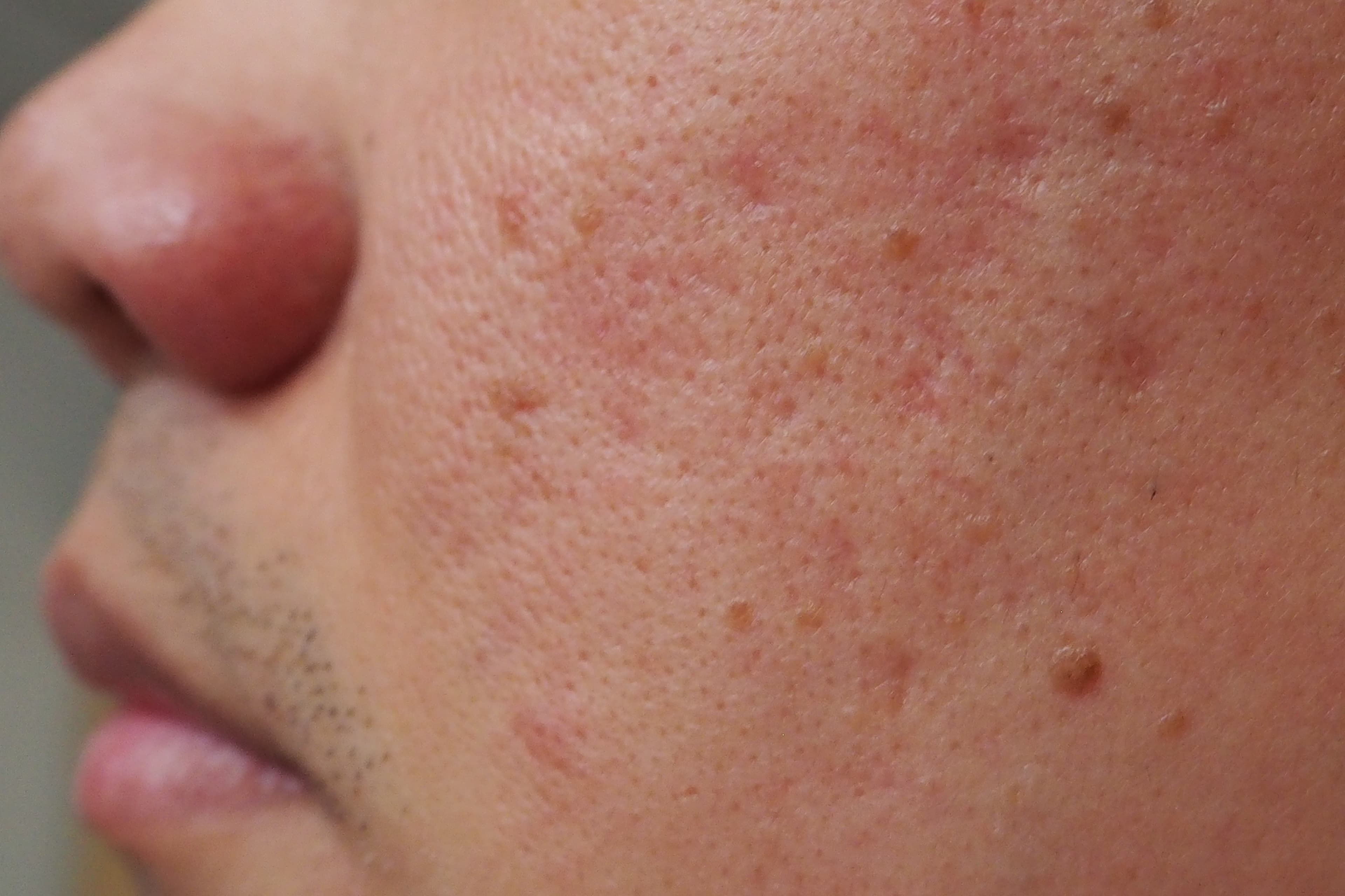 Accutane Office Visit