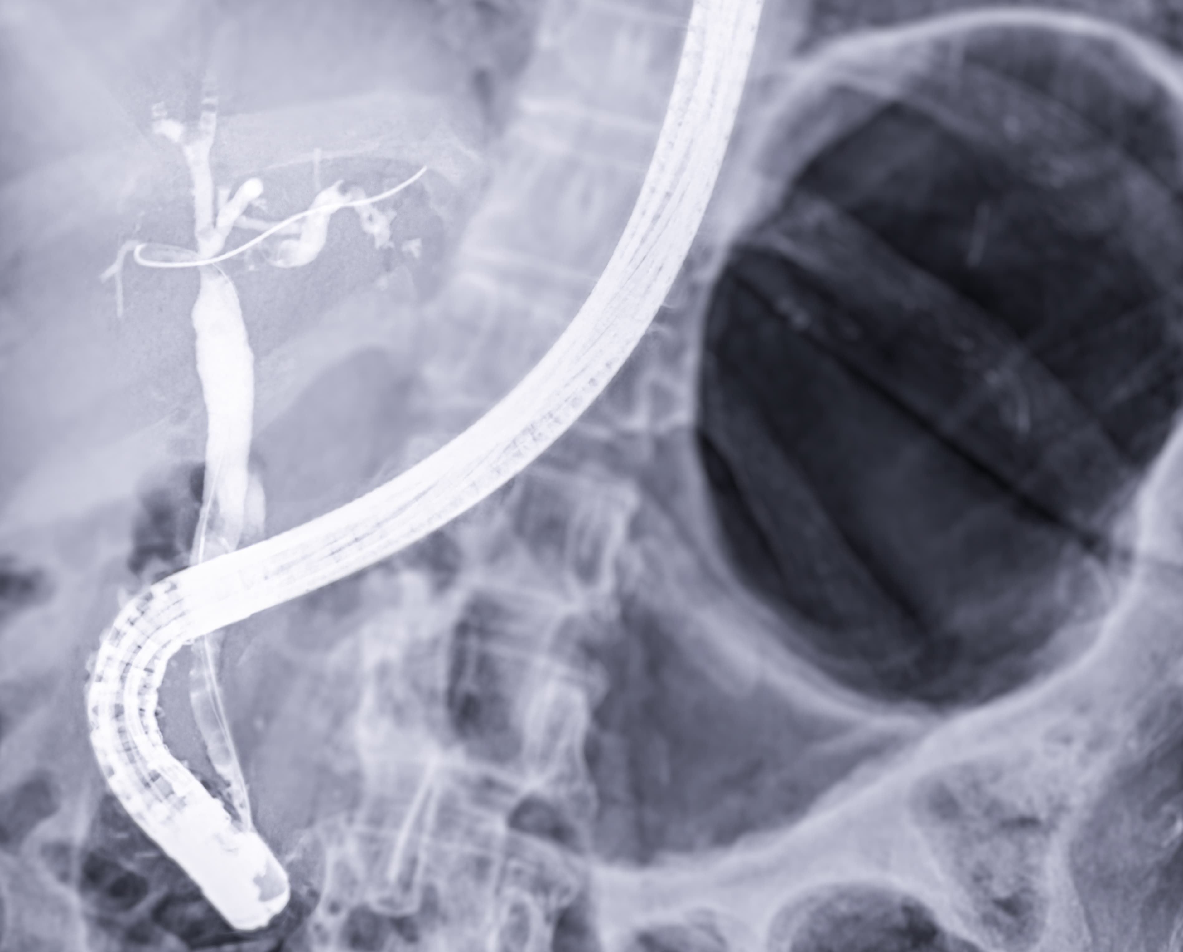 ERCP