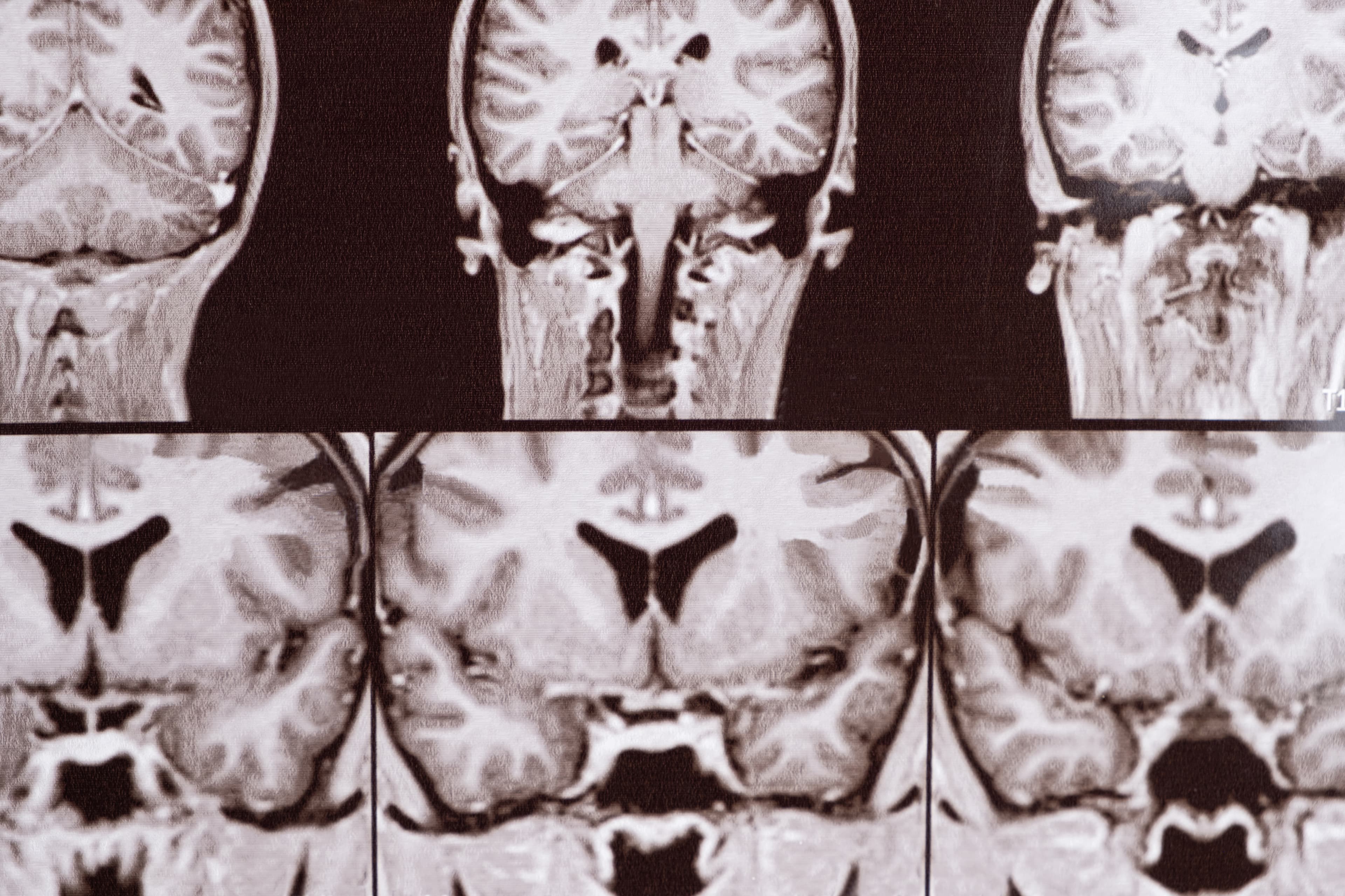 Pituitary Disorder Evaluation