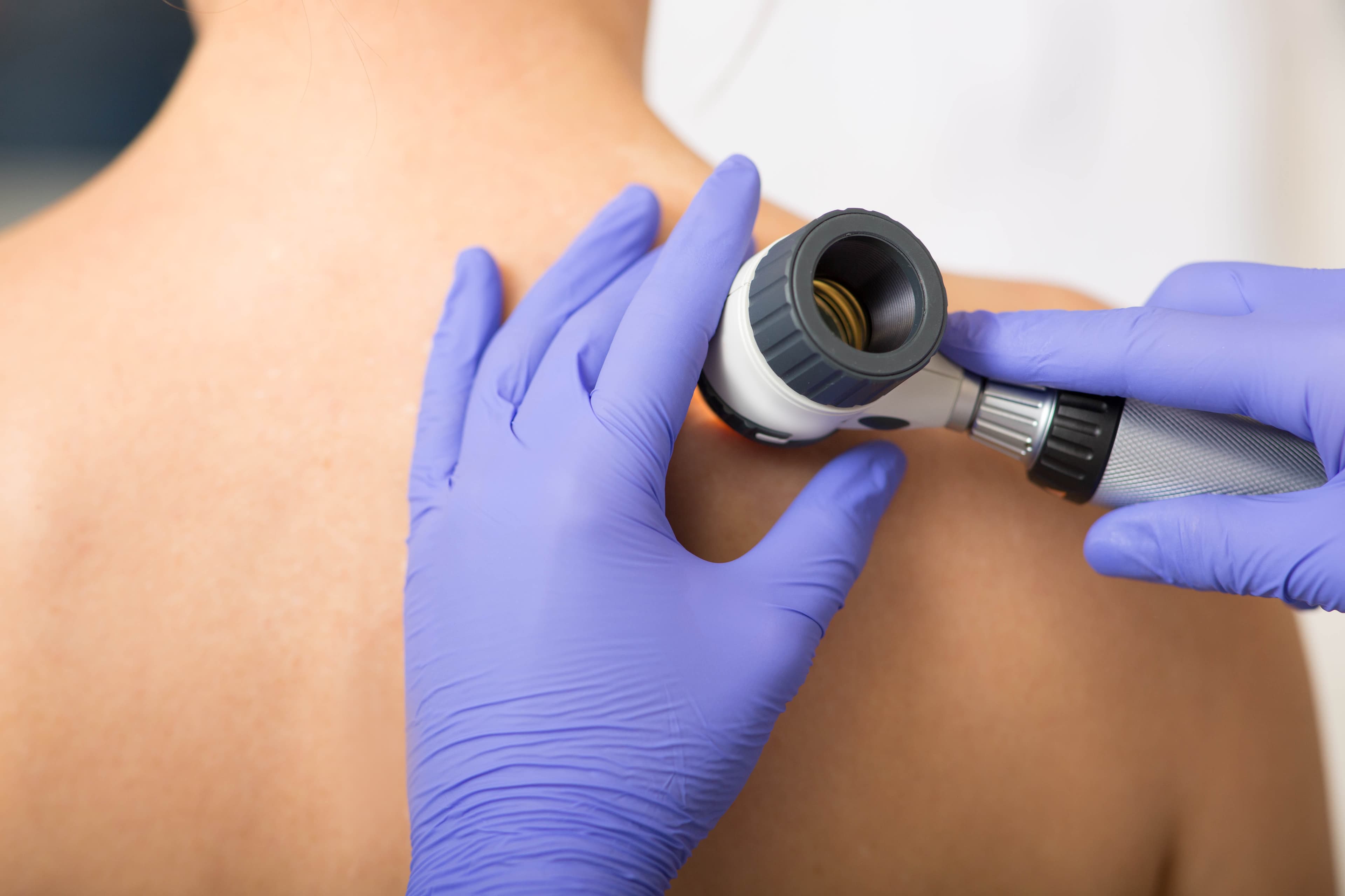 Skin lesion excision (benign/suspicious)