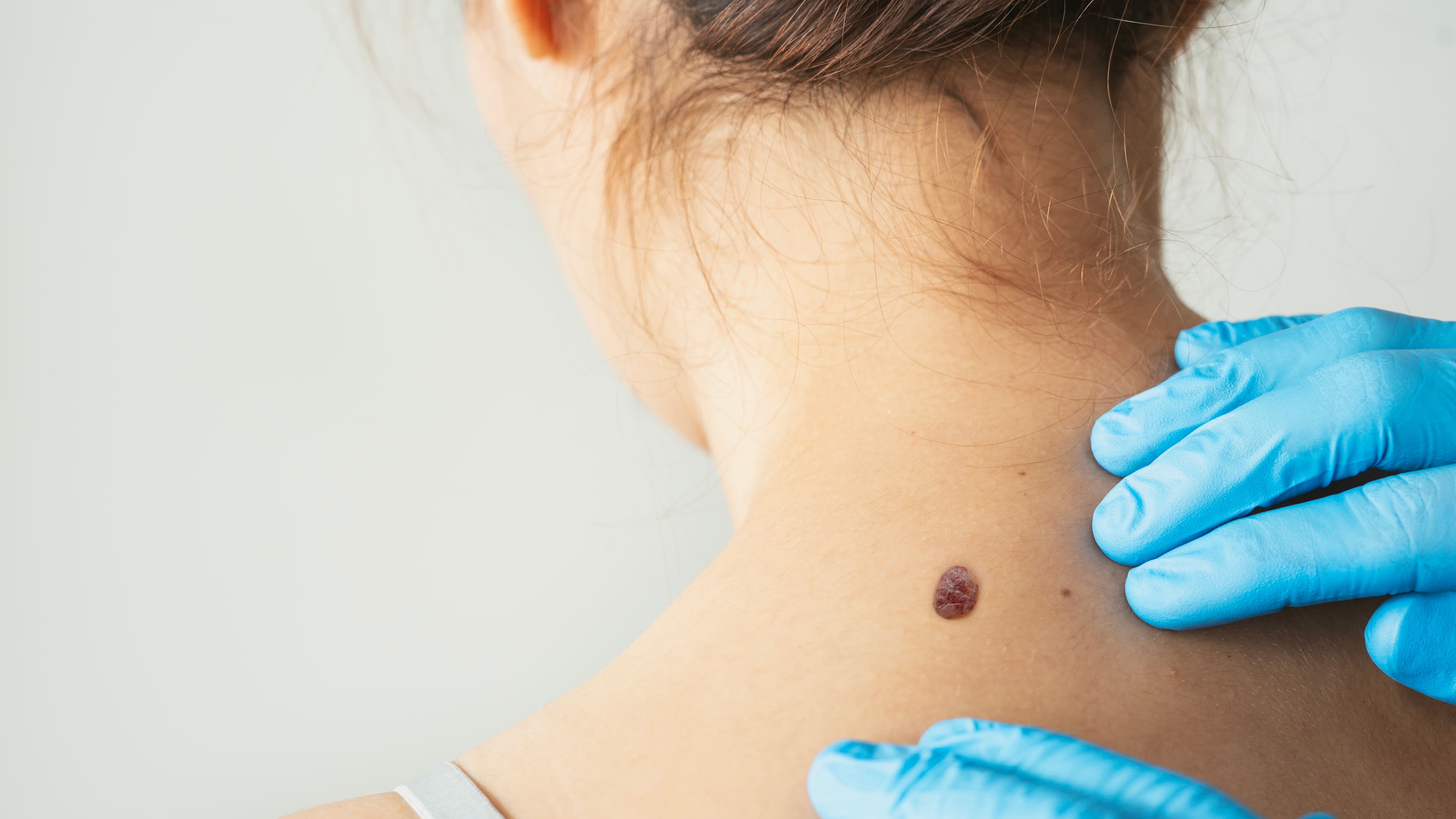 Mole/nevus excision