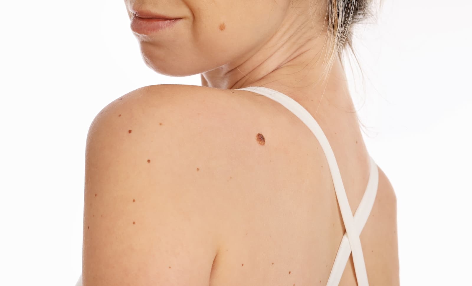 dermatology-consult